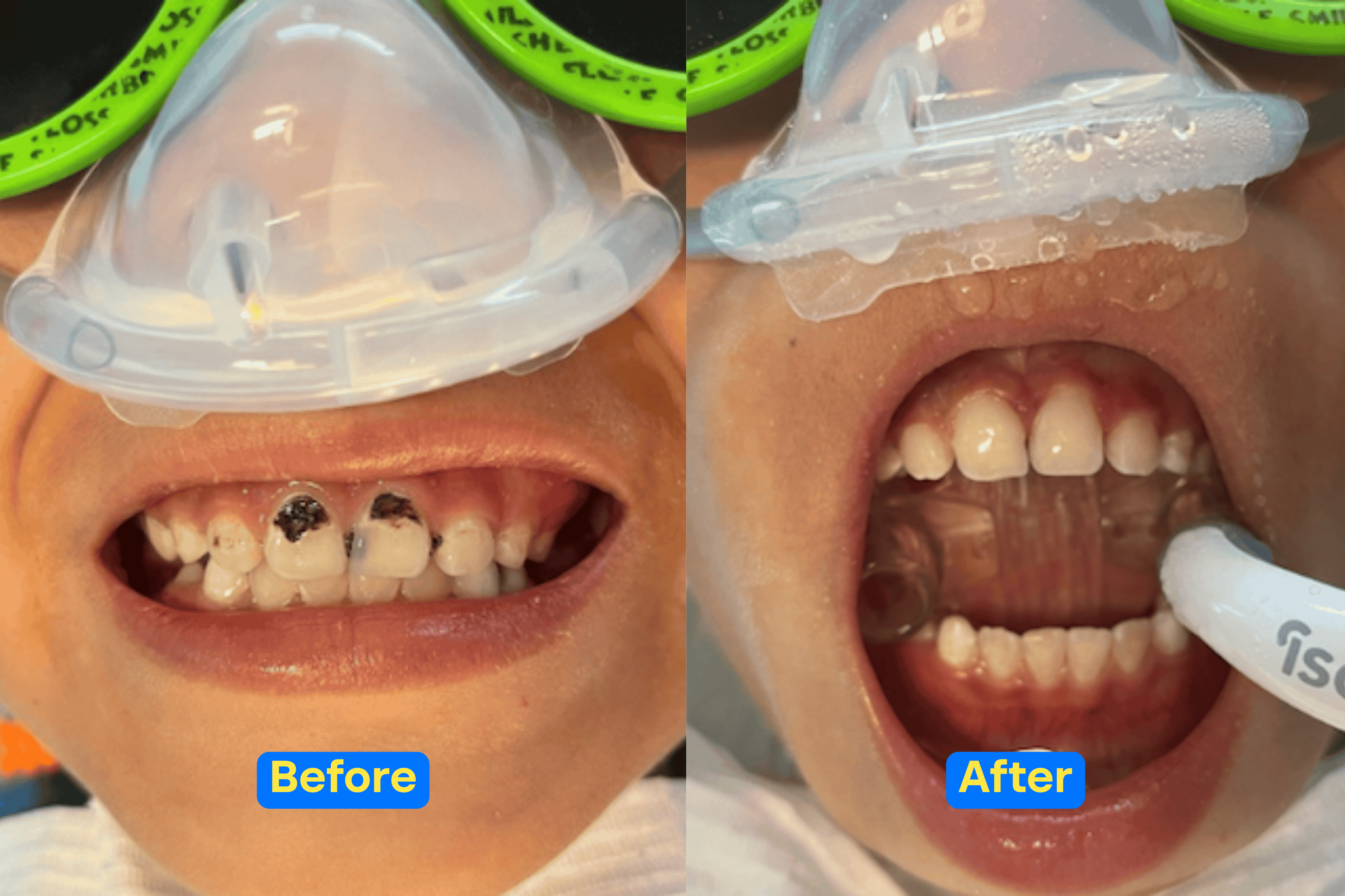 Side-by-side images showing a child's teeth before and after dental treatment, with severe tooth decay visible before and clean, healthy teeth after.