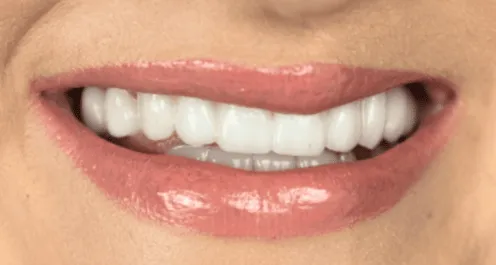 metamorfoza-usmiechu-bydgoszcz-po-implantacja