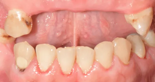 metamorfoza-usmiechu-bydgoszcz-przed-implantacja