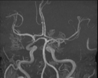MRT Angio