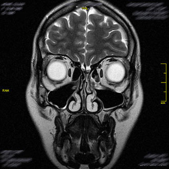 MRT Nasennebenhöhlen