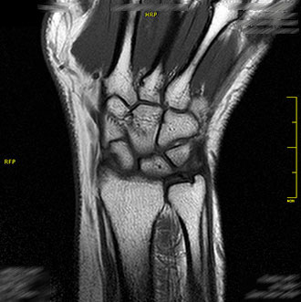 MRT Handgelenk
