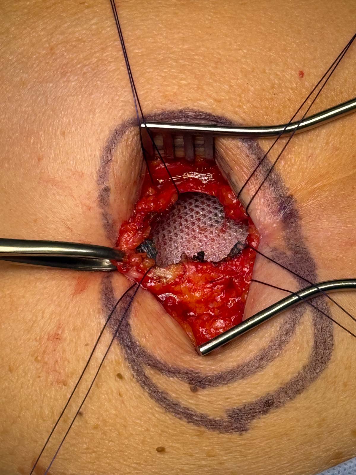 Surgical view of a midline abdominal hernia repair showing exposed tissue and implanted mesh secured with sutures and retractors.