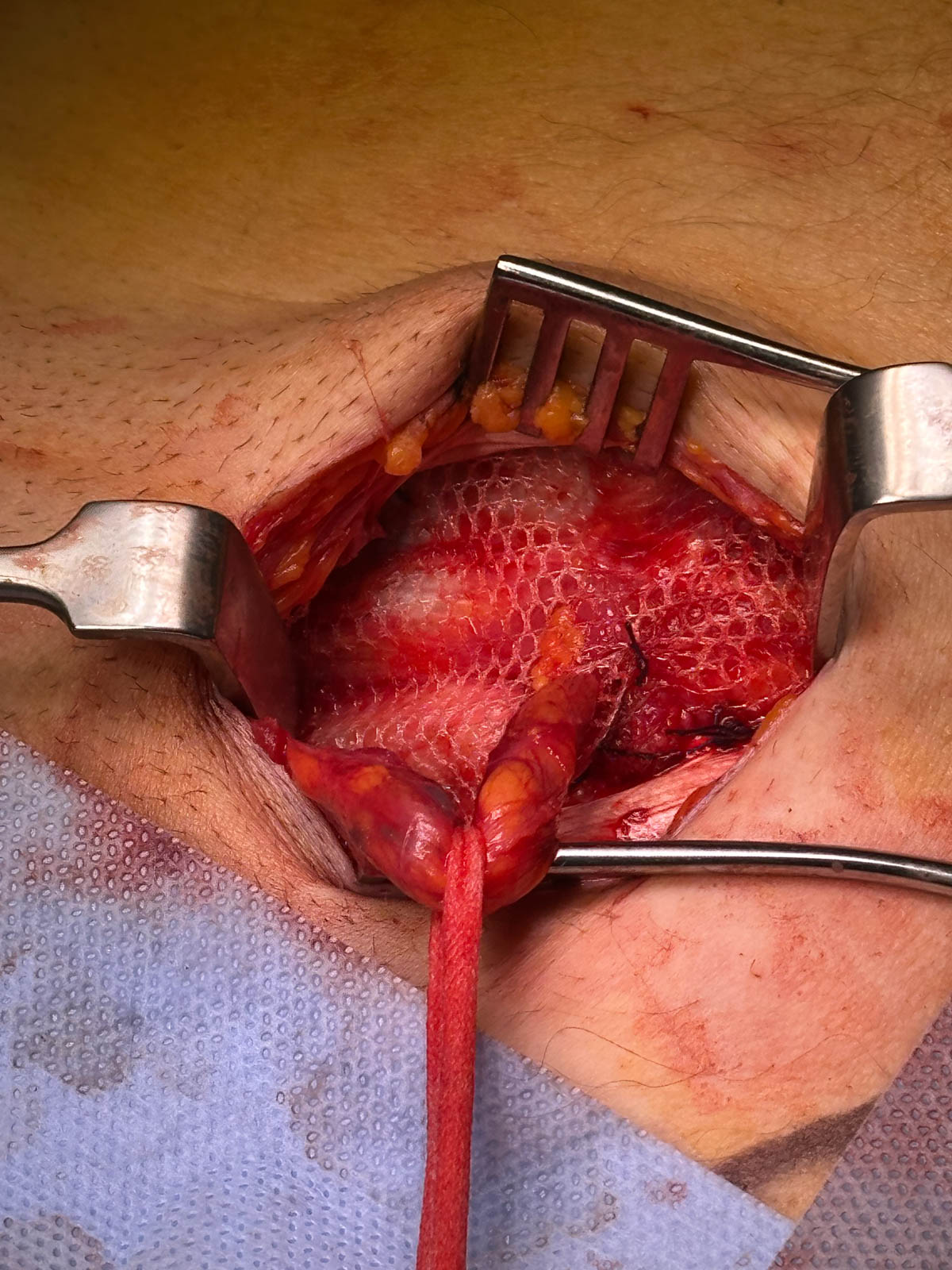 Surgical view of an open inguinal hernia repair with a mesh implant and exposed tissue held by retractors.