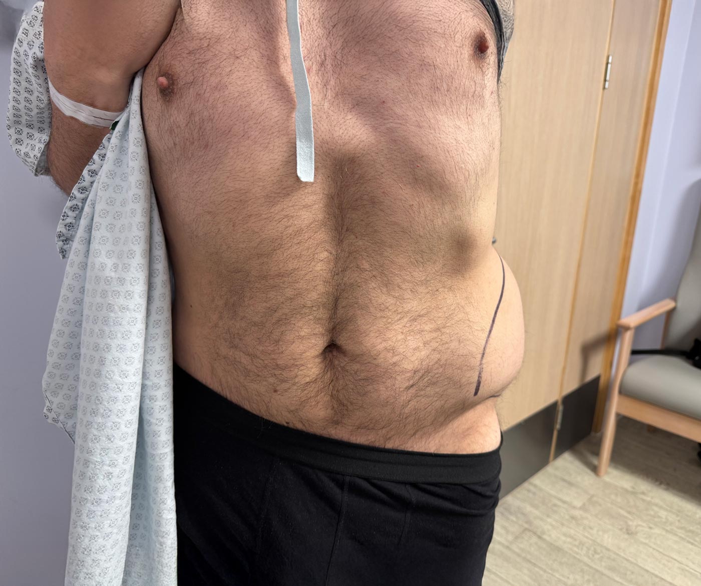 Close-up of a man's hairy torso with a surgical marker line drawn on the right side of the abdomen, standing in a medical room.