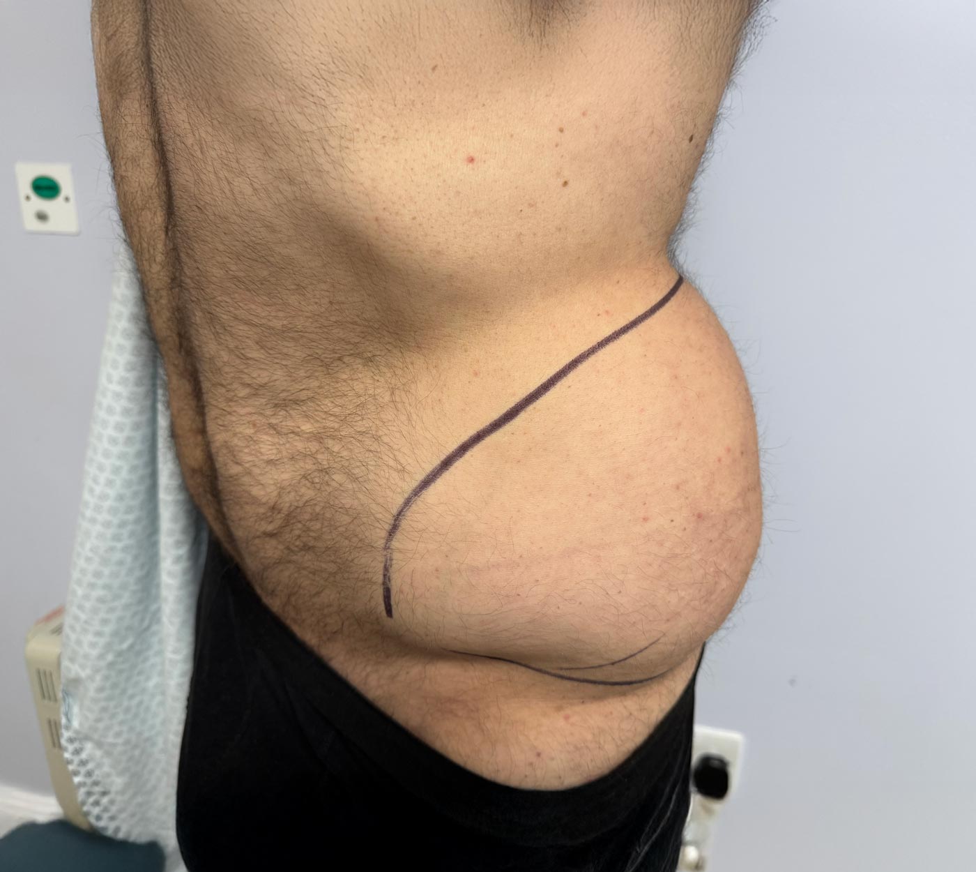 Side view of a bare male torso with surgical marker lines on the lower abdomen over skin with some hair and small spots.