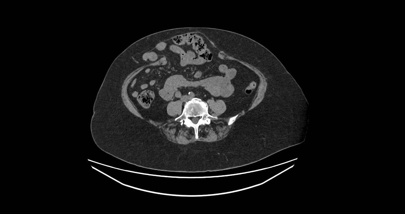 Incisional Hernia Image