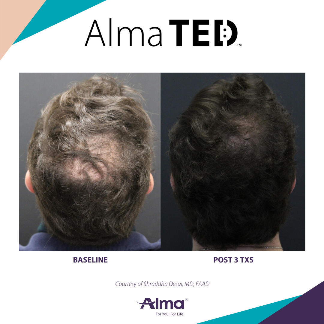 Before and after photos of a man's scalp showing hair regrowth at the crown after Alma TED treatment.