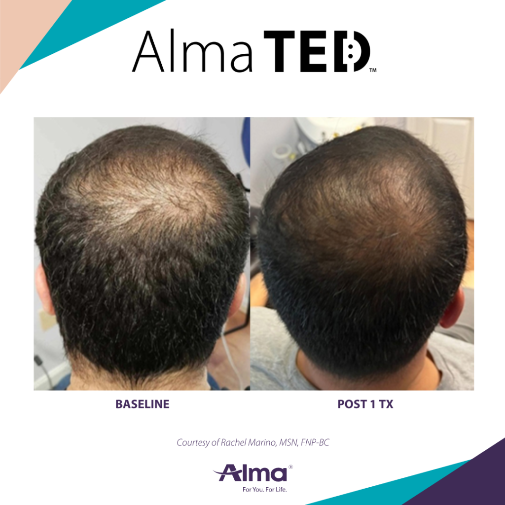 Comparison of a man's scalp before and after one Alma TED treatment showing reduced hair thinning on the crown.