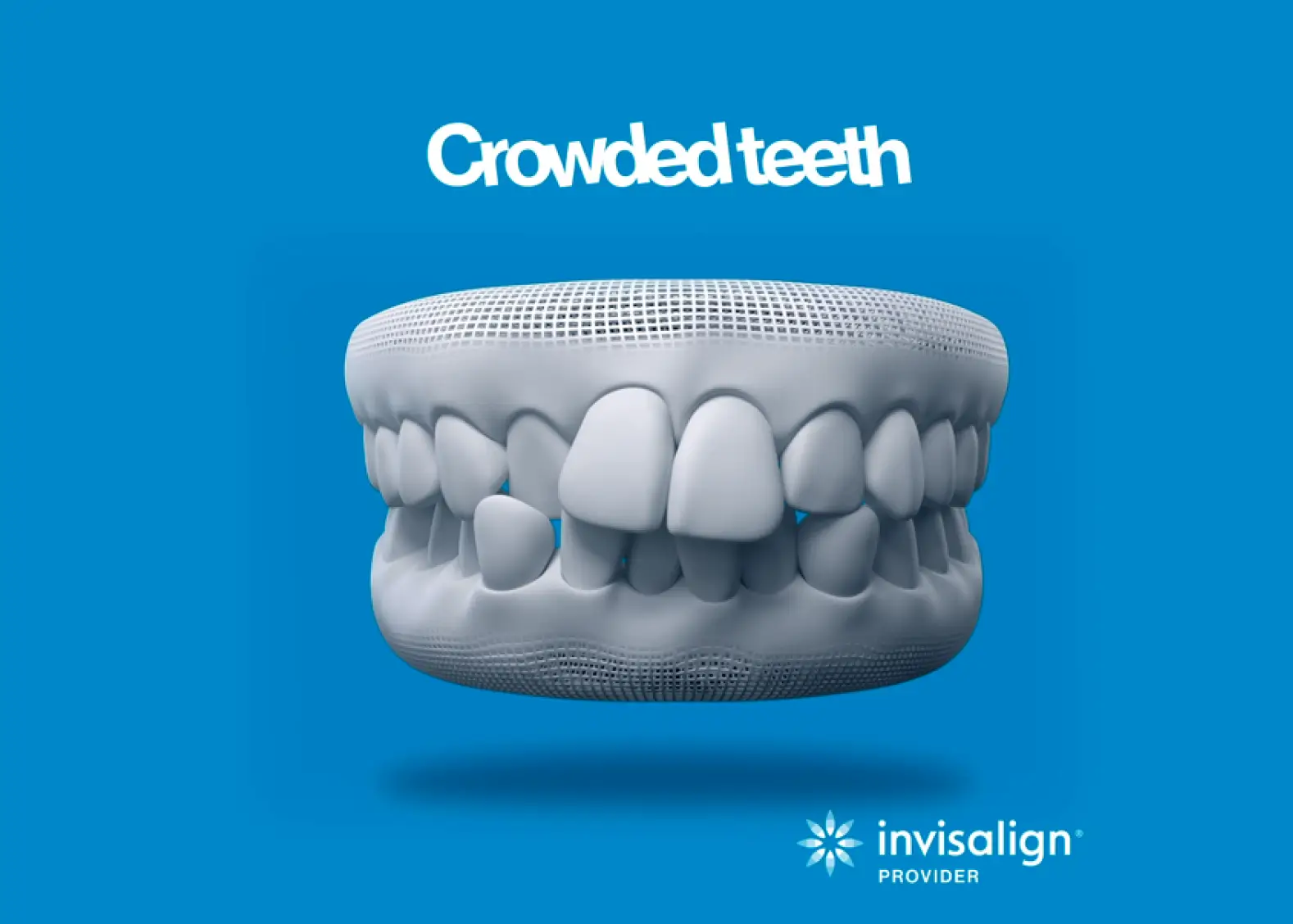 3D model showing crowded teeth with overlapping and misaligned teeth on a blue background, Invisalign provider logo at the bottom.