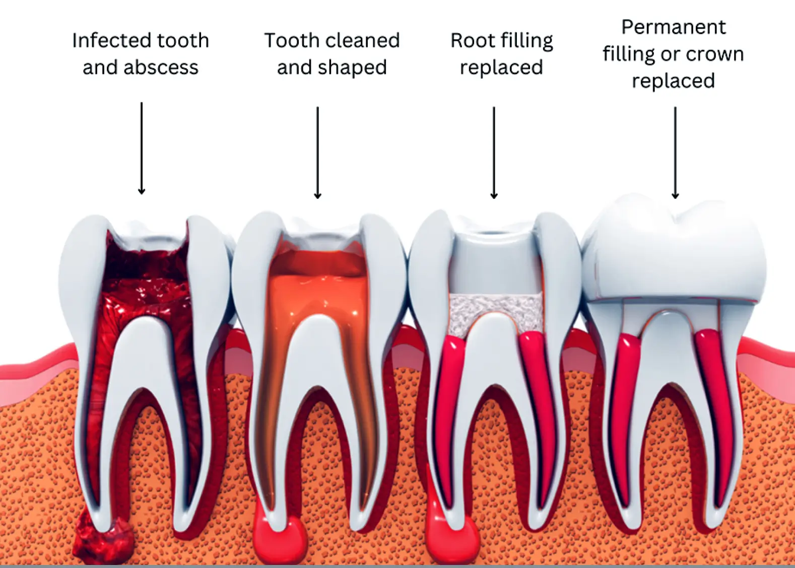 Four stages of tooth treatment: infected tooth with abscess, tooth cleaned and shaped, root filling replaced, and permanent filling or crown replaced.