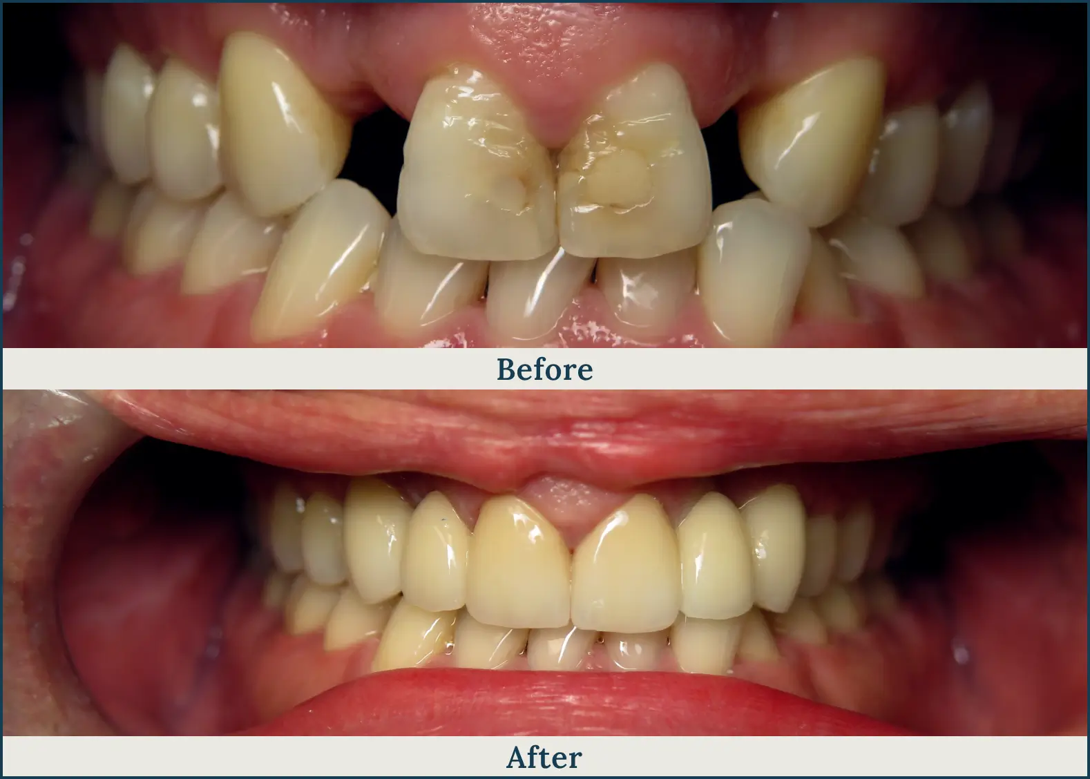 Close-up of teeth before and after dental treatment, showing decayed and chipped front teeth restored to healthy appearance.