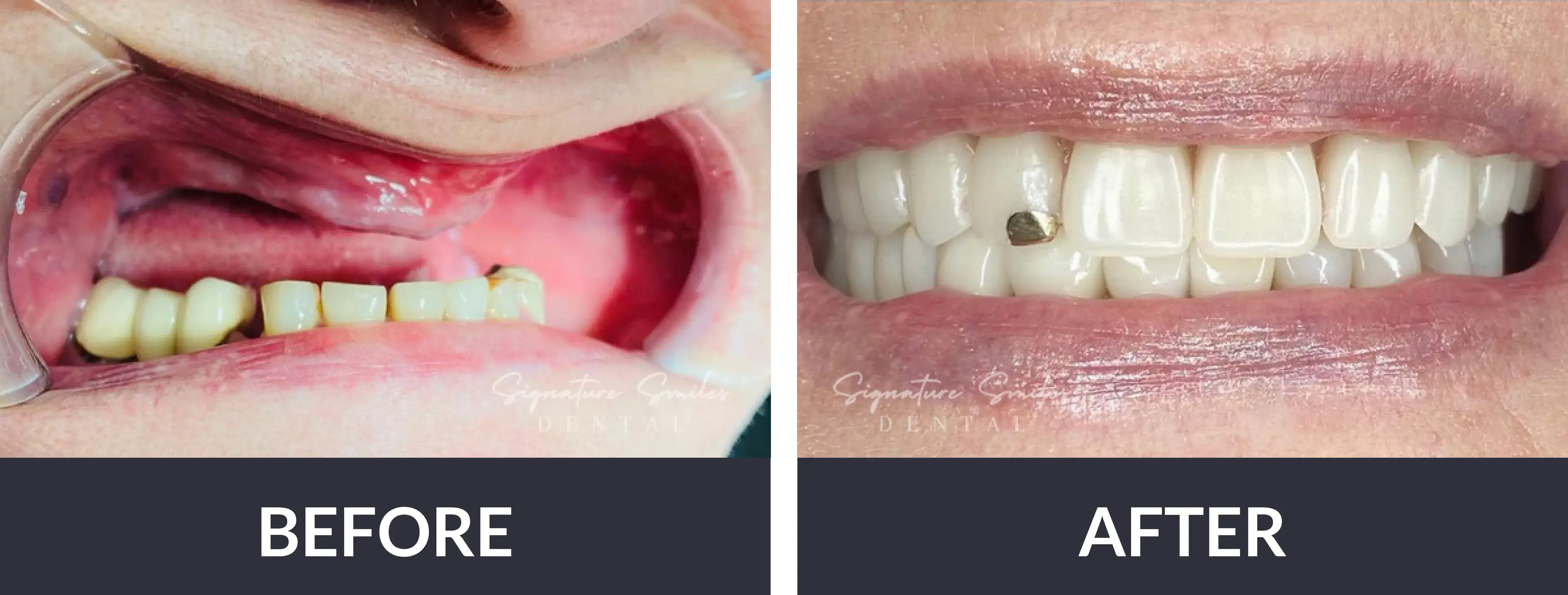 A before and after picture of a woman's teeth.
