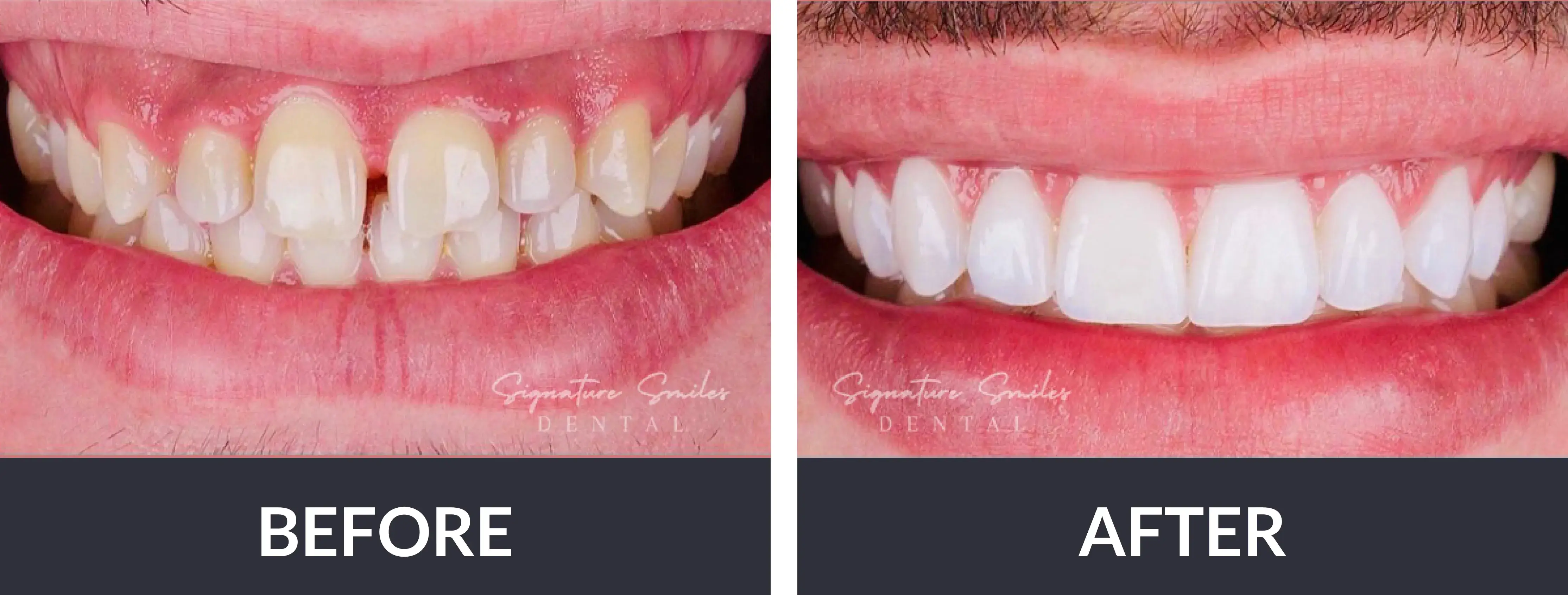 A before and after picture of a man's teeth.