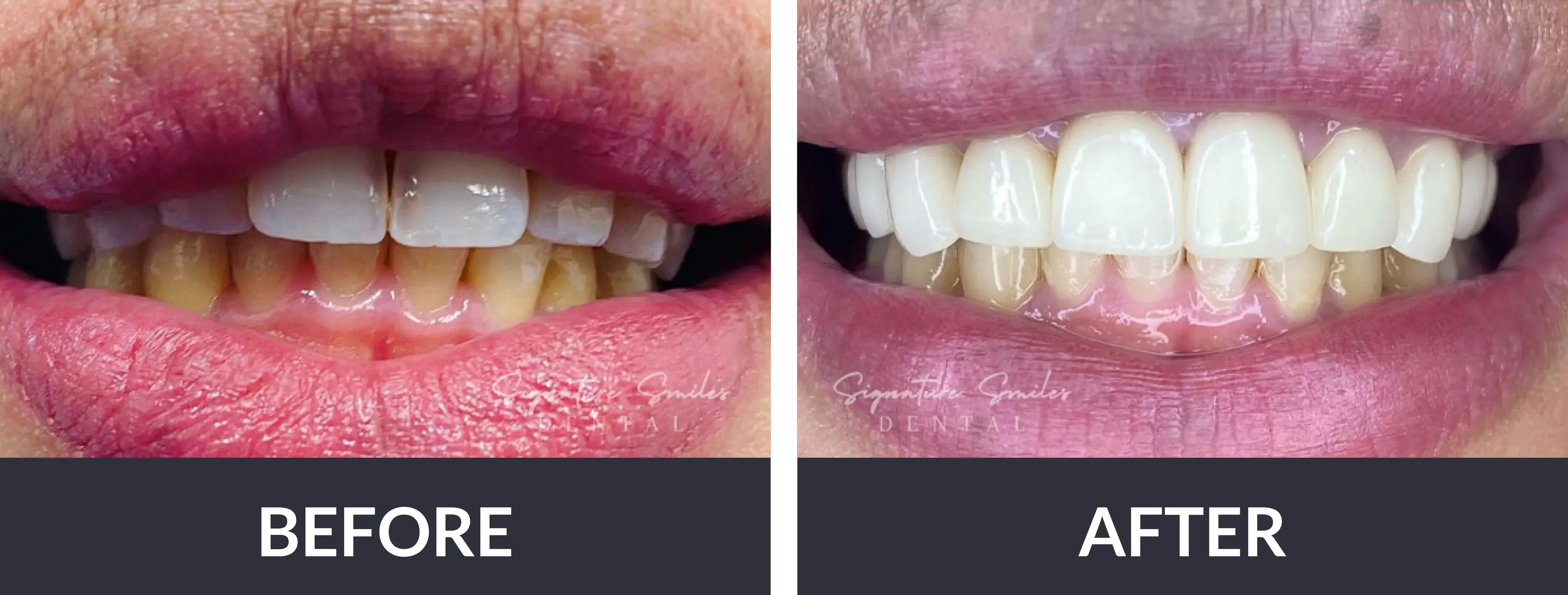 A woman's teeth before and after whitening.