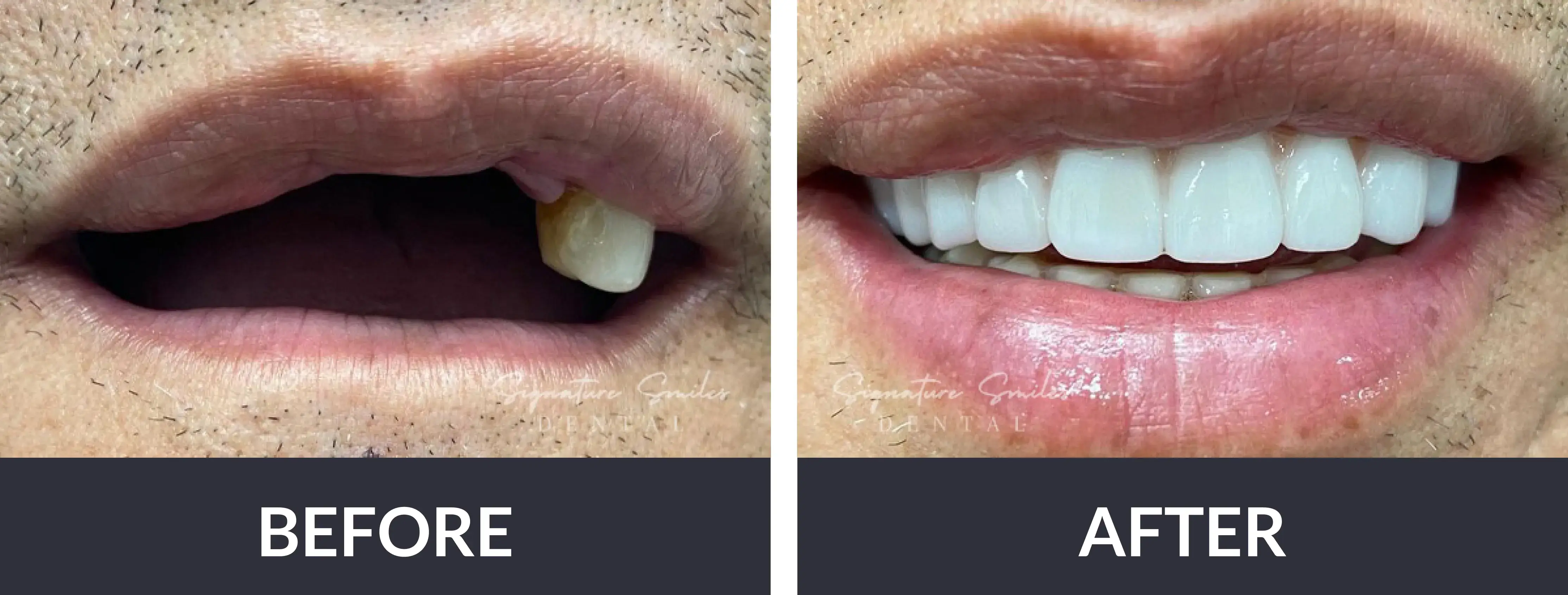 A before and after picture of a man's teeth.