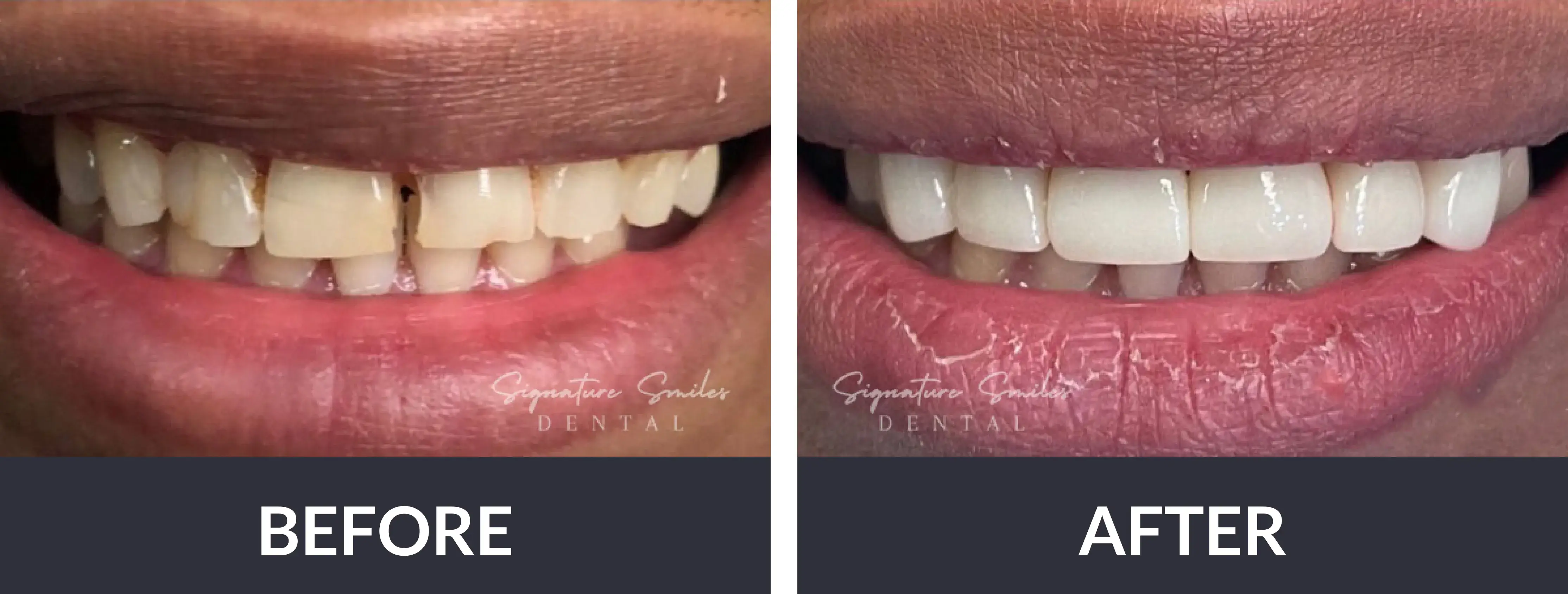 A woman's teeth before and after whitening.