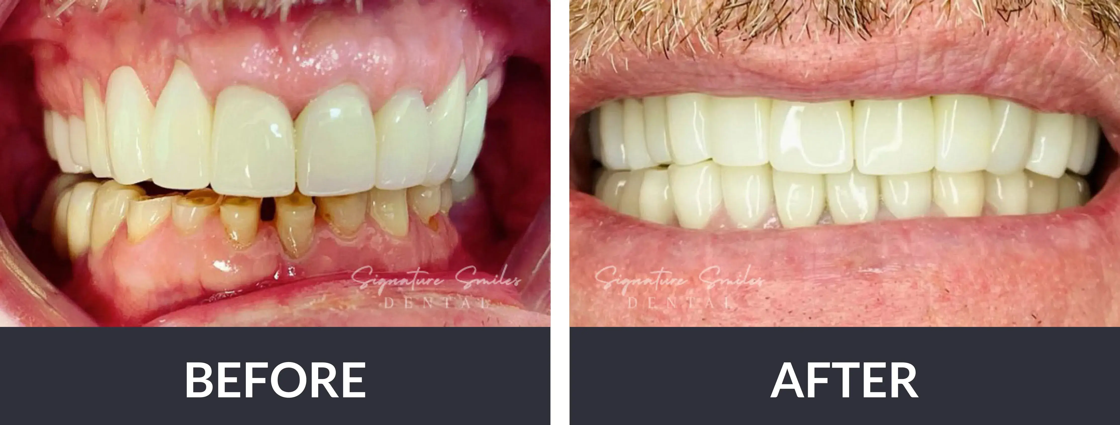 A before and after picture of a man's teeth.