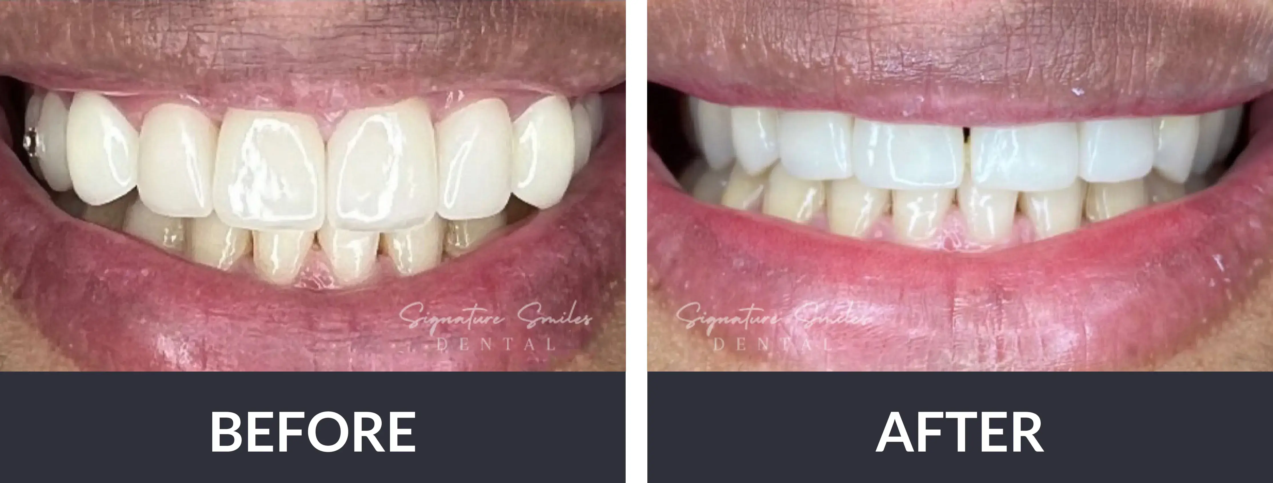 The before and after of a smile makeover.