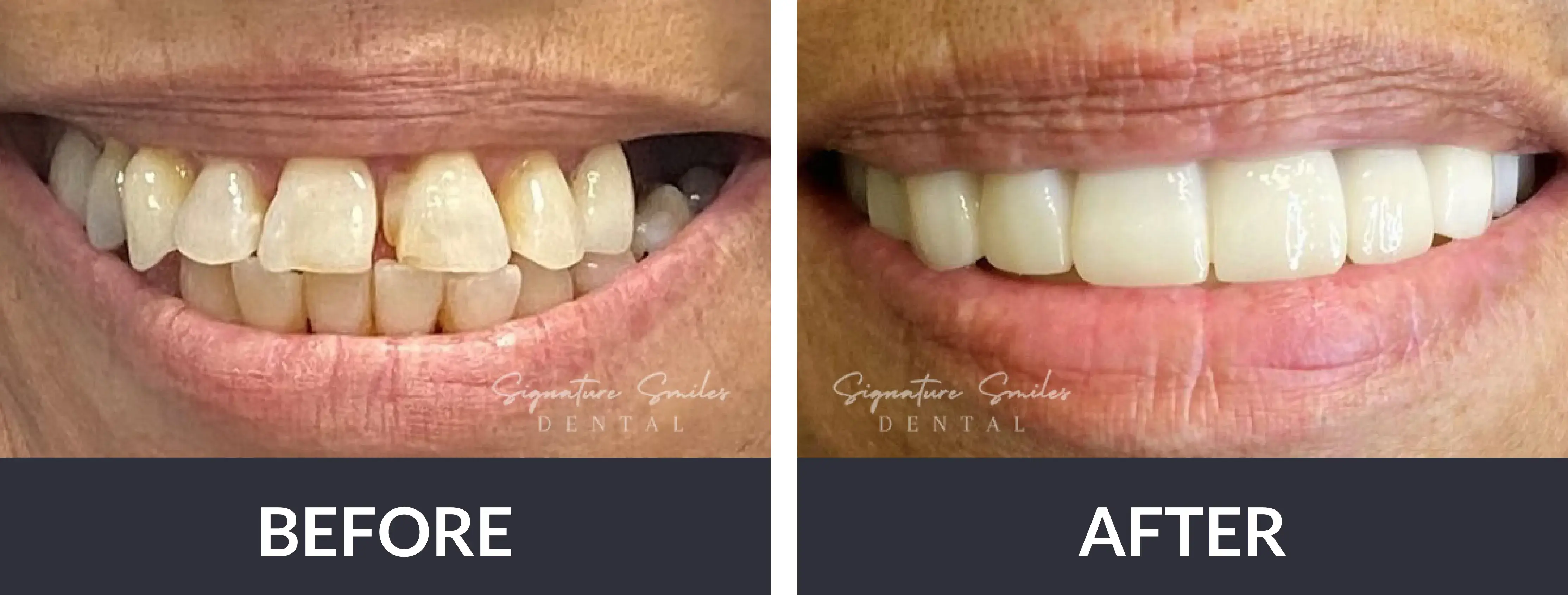 A woman's teeth before and after dental treatment.