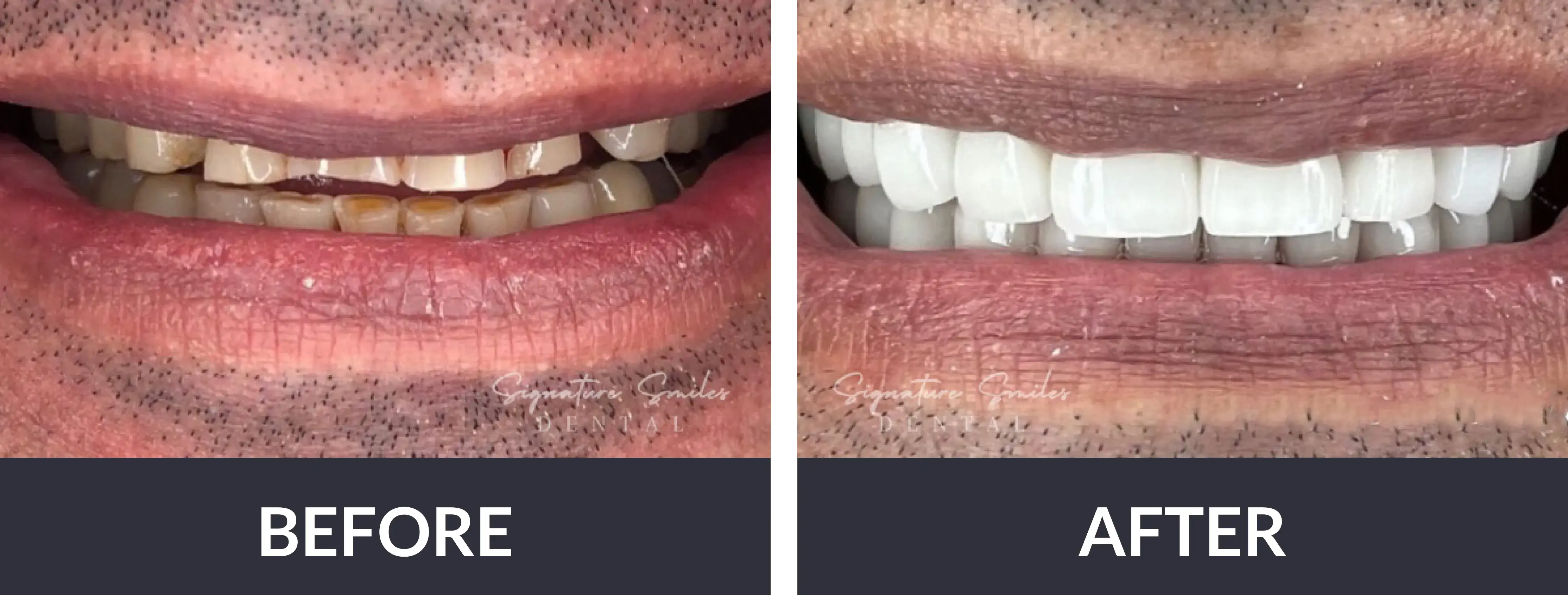 The before and after of a smile makeover.
