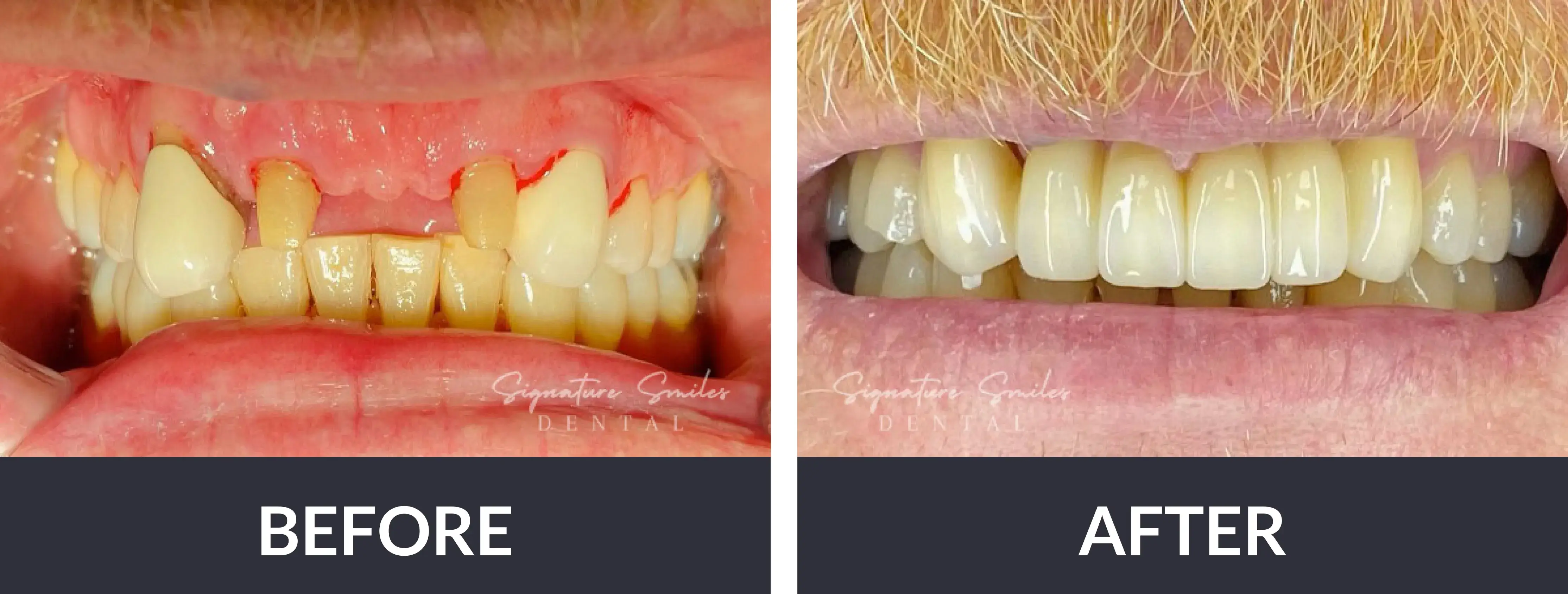 A before and after picture of a man's teeth.