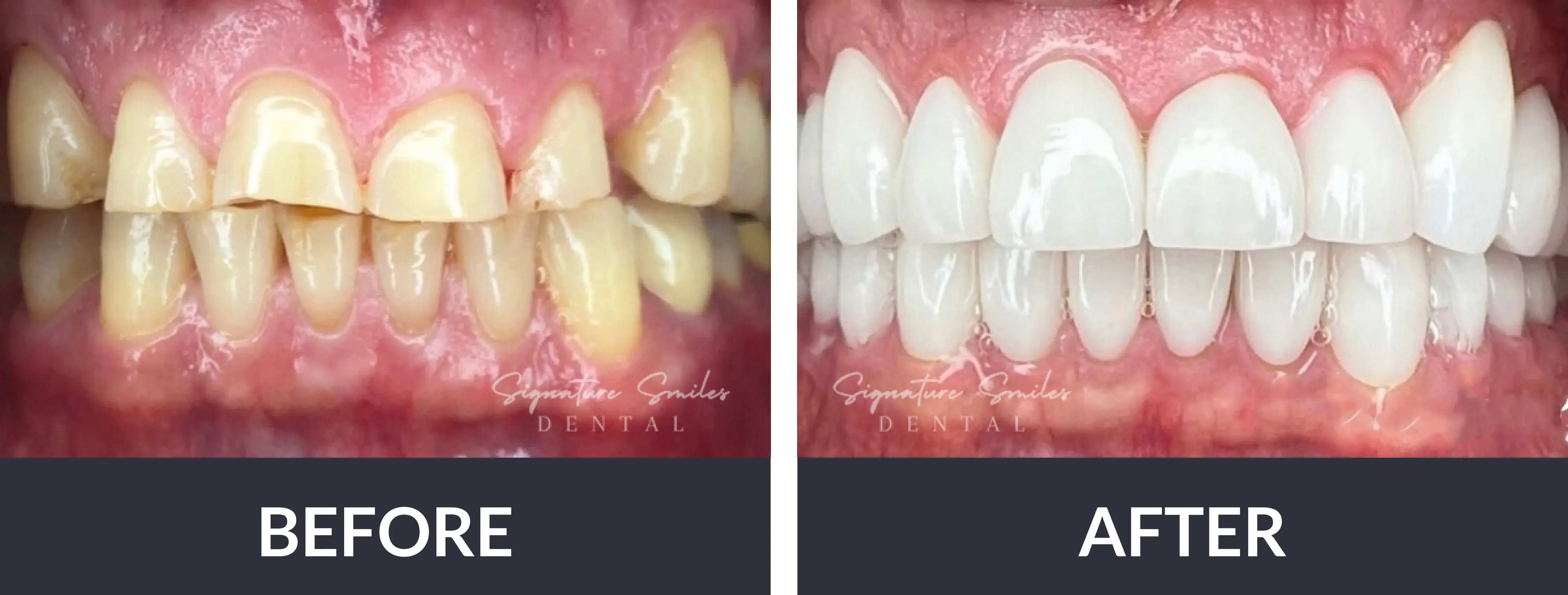 A before and after picture of a smile makeover.