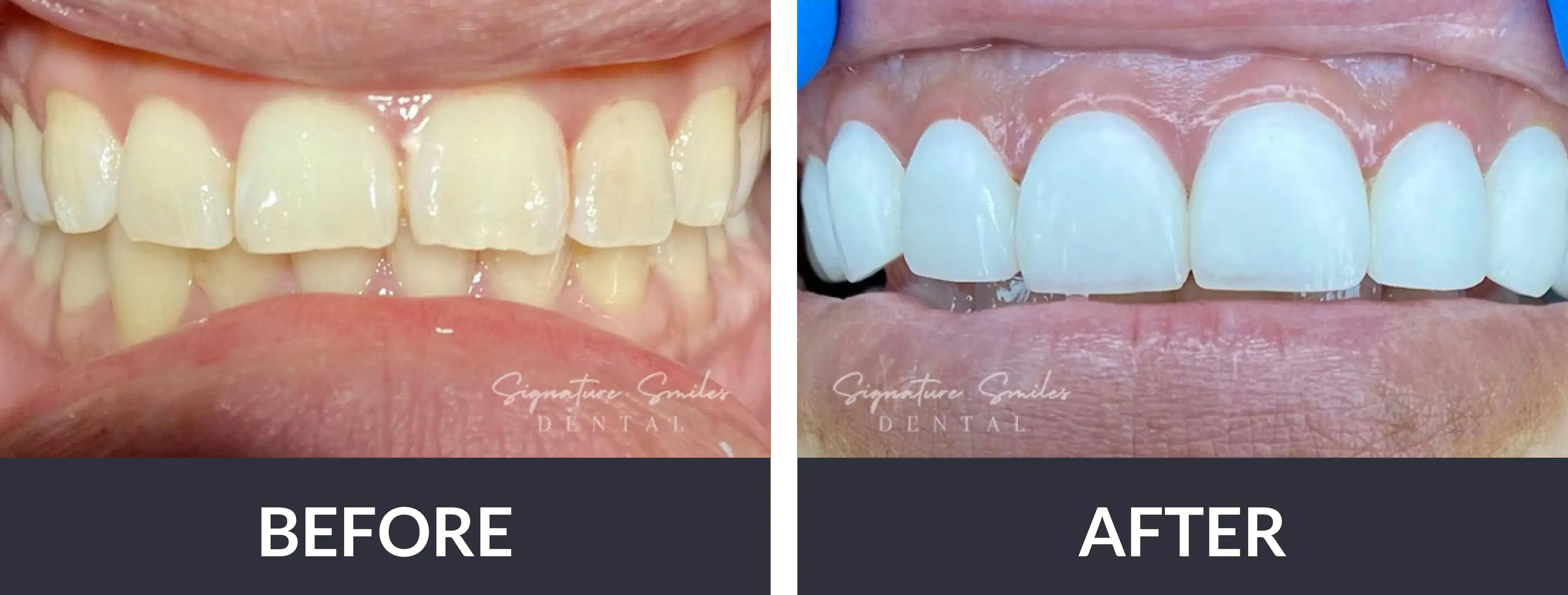 The before and after of a smile makeover.