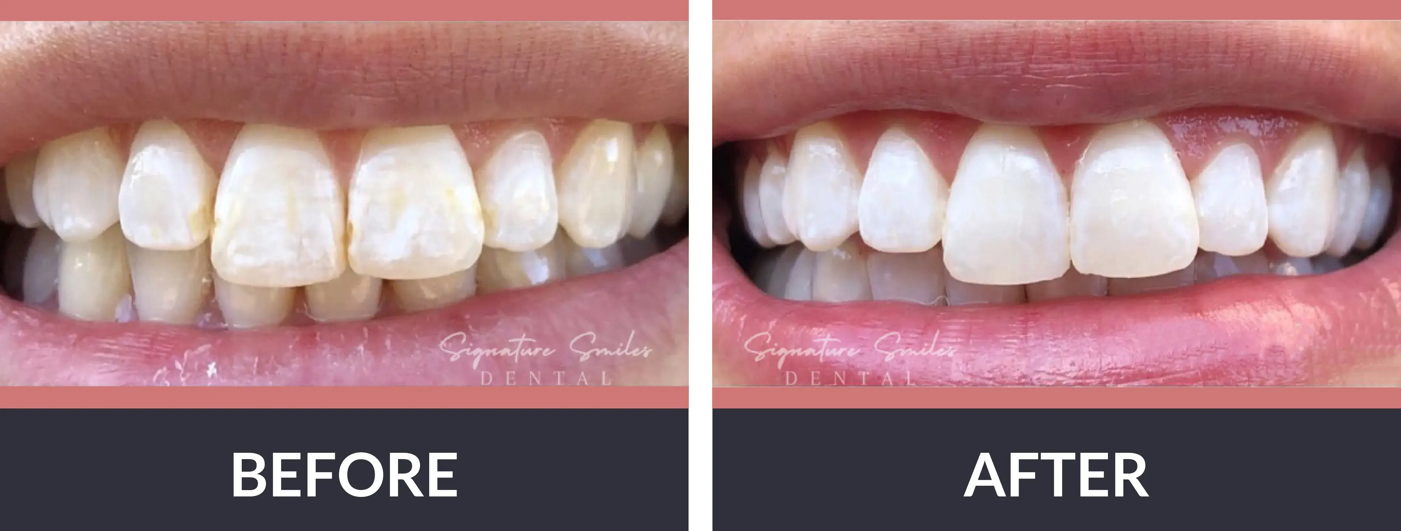A woman's teeth before and after whitening.