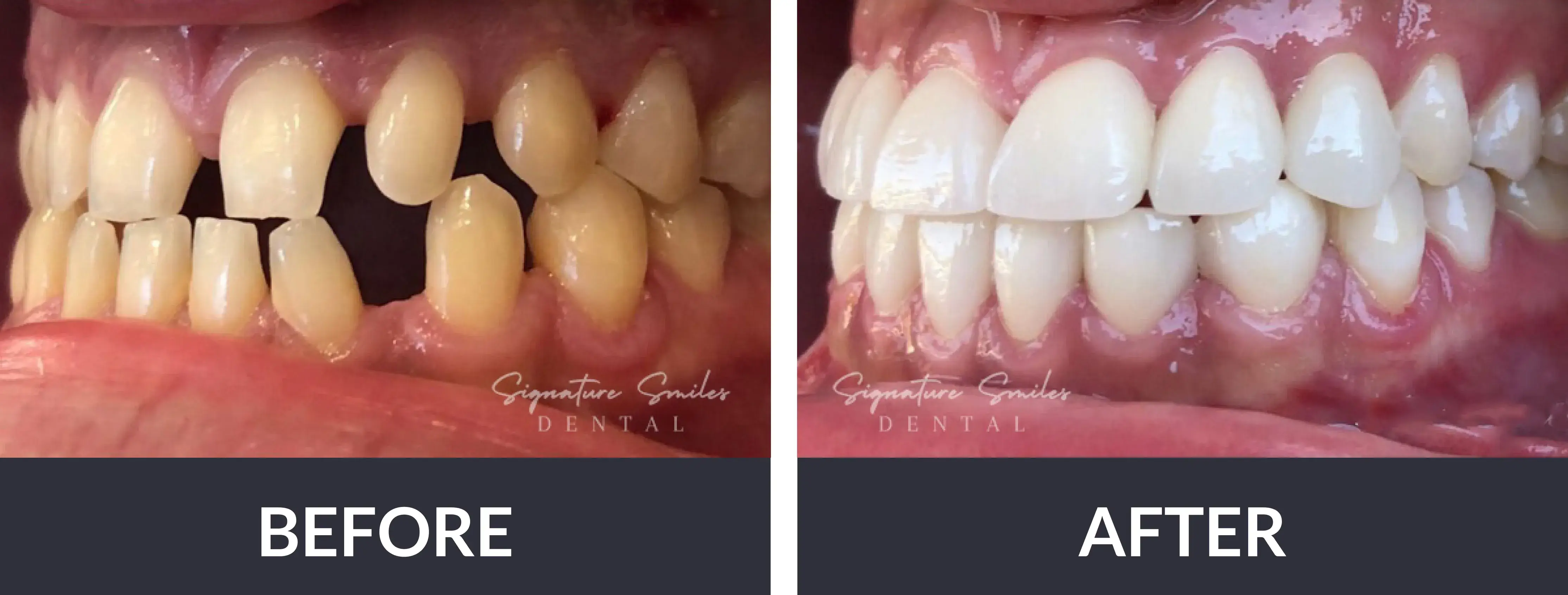 A before and after picture of a smile makeover.