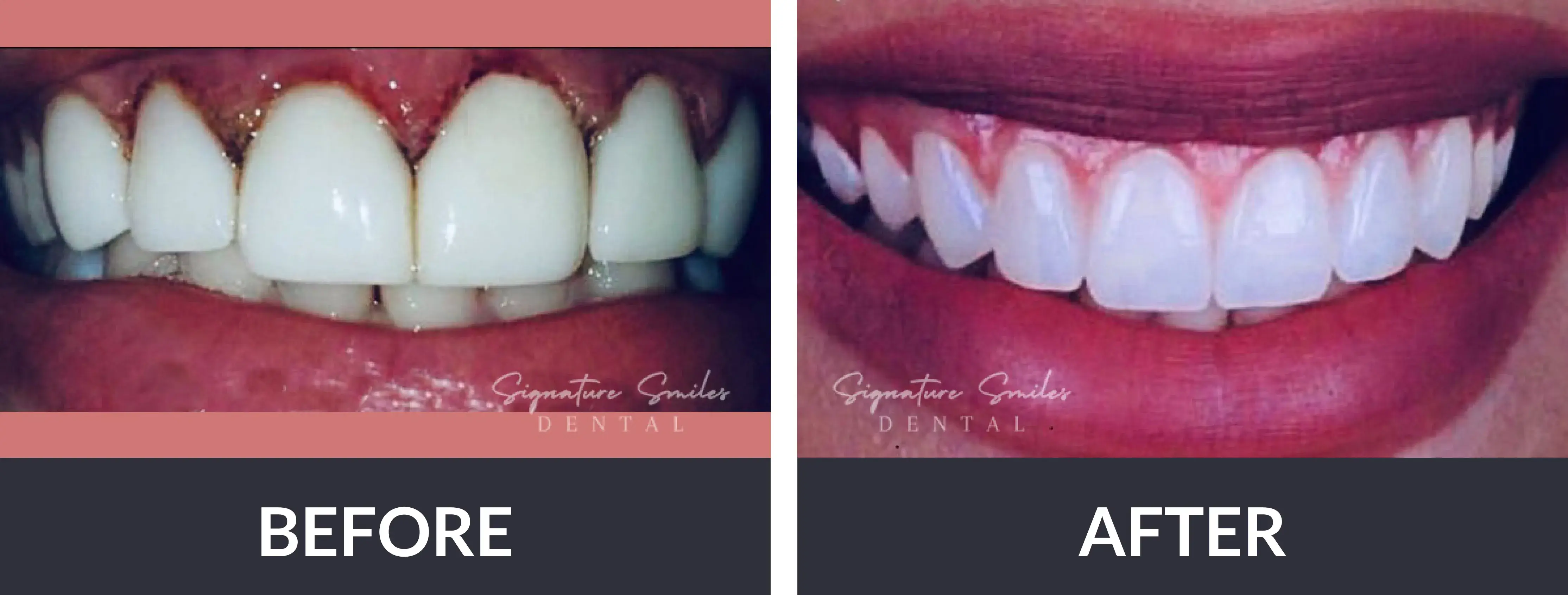 A woman's teeth before and after whitening.