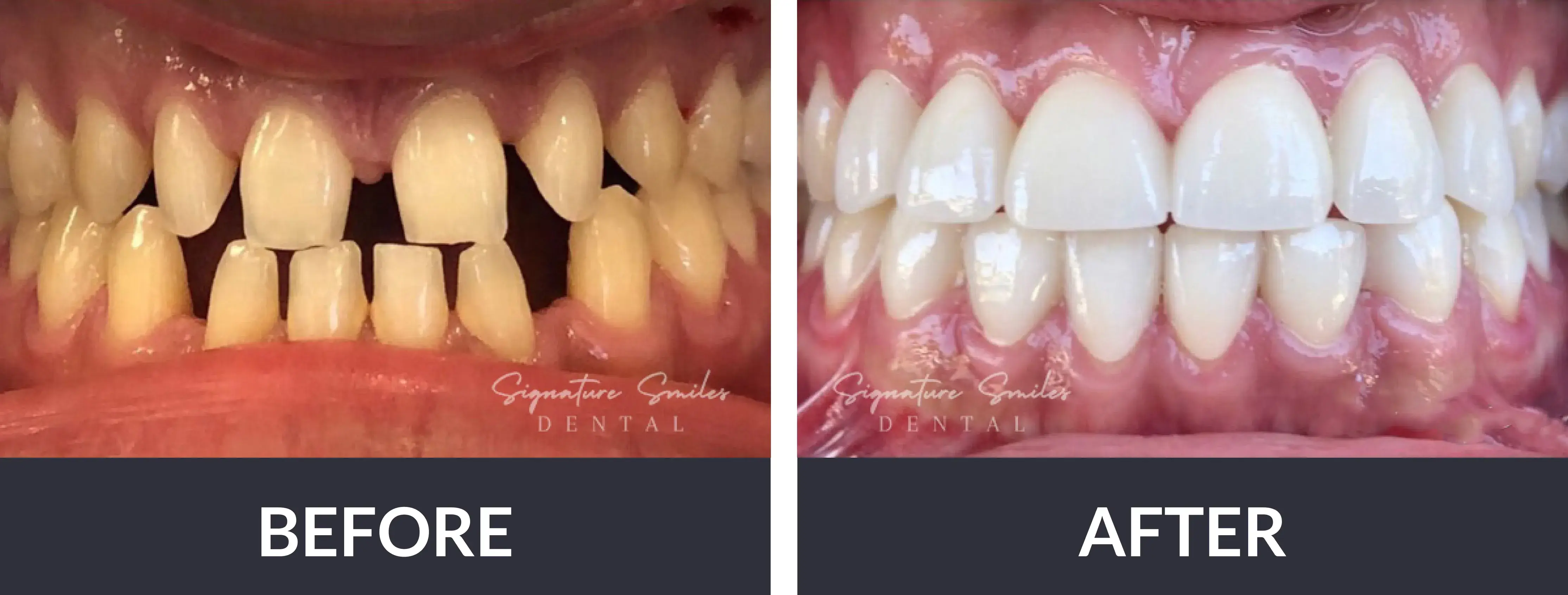 A before and after picture of a smile makeover.