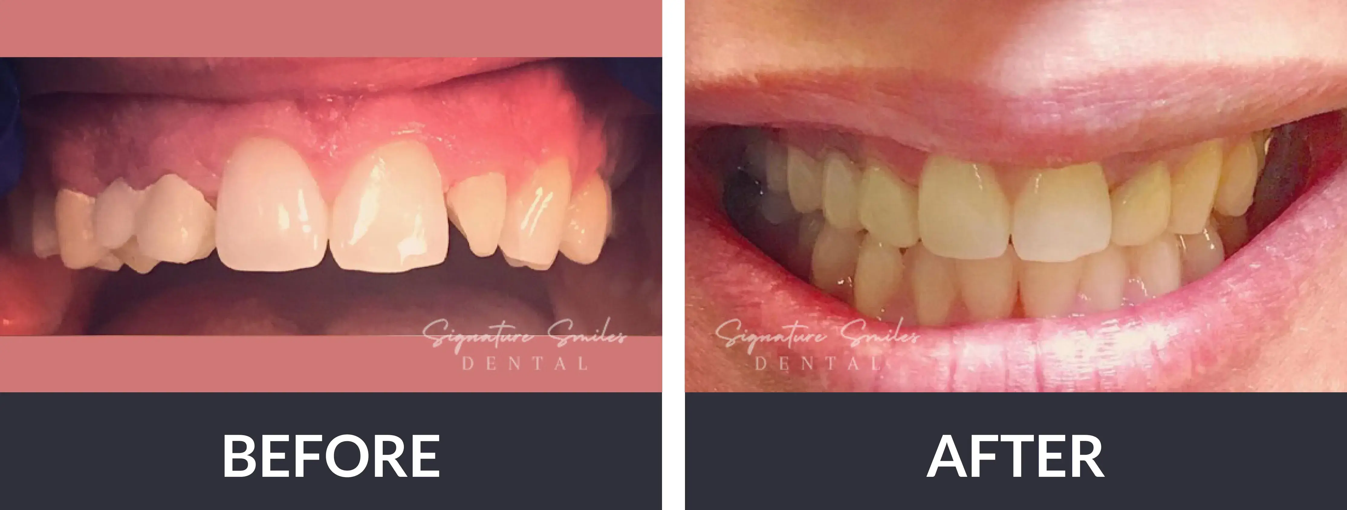 A before and after picture of a woman's teeth.