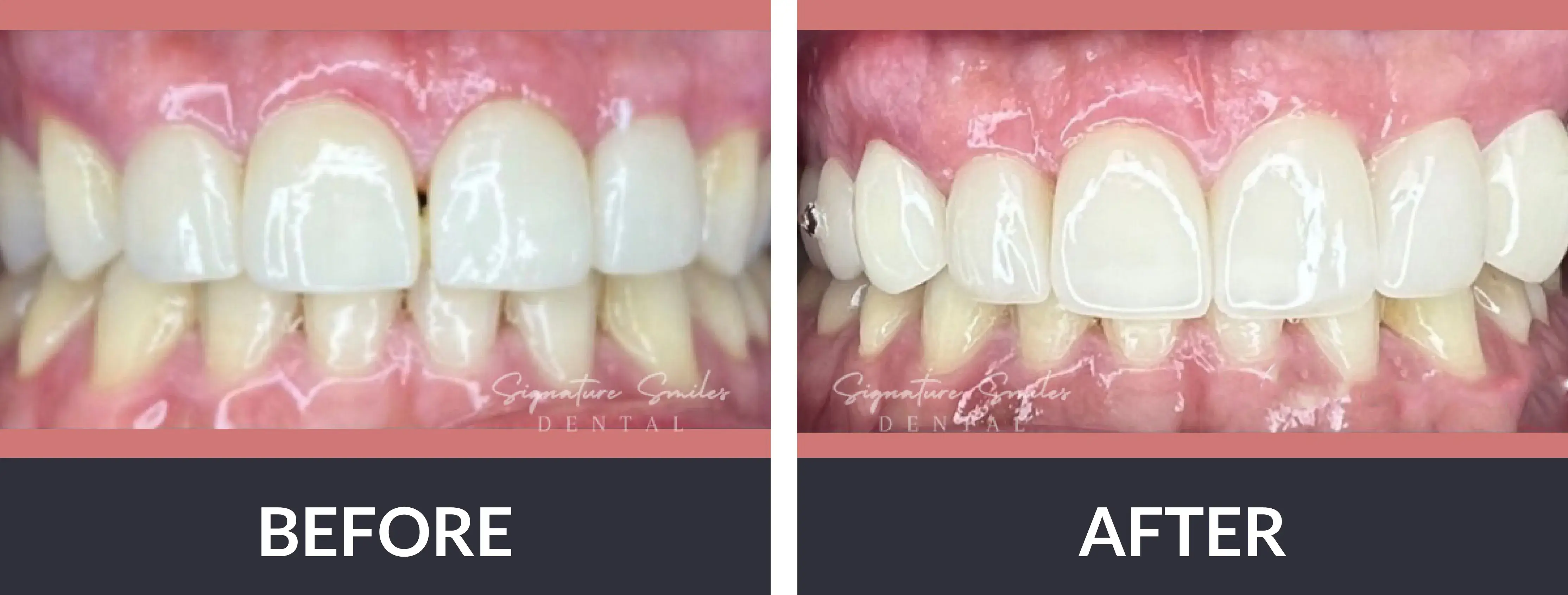A before and after picture of a smile makeover.