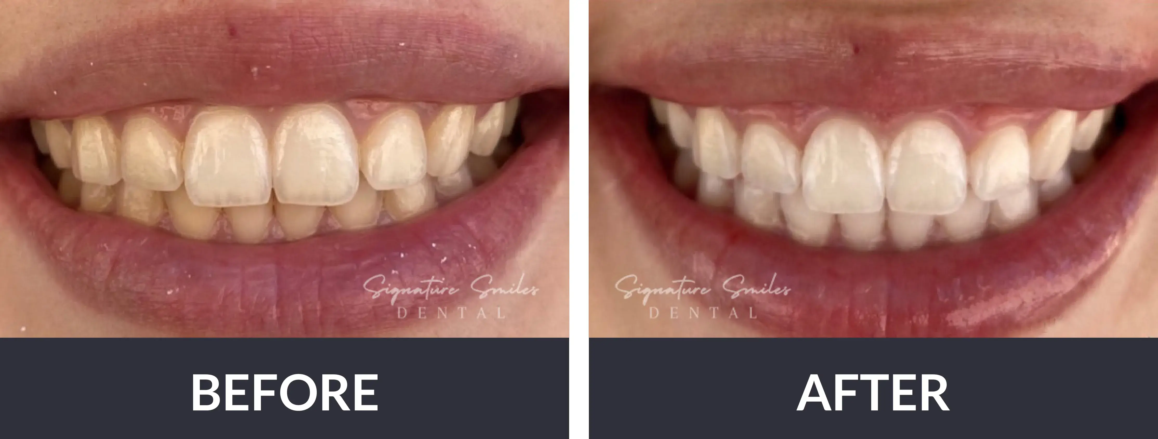 A woman's teeth before and after whitening.