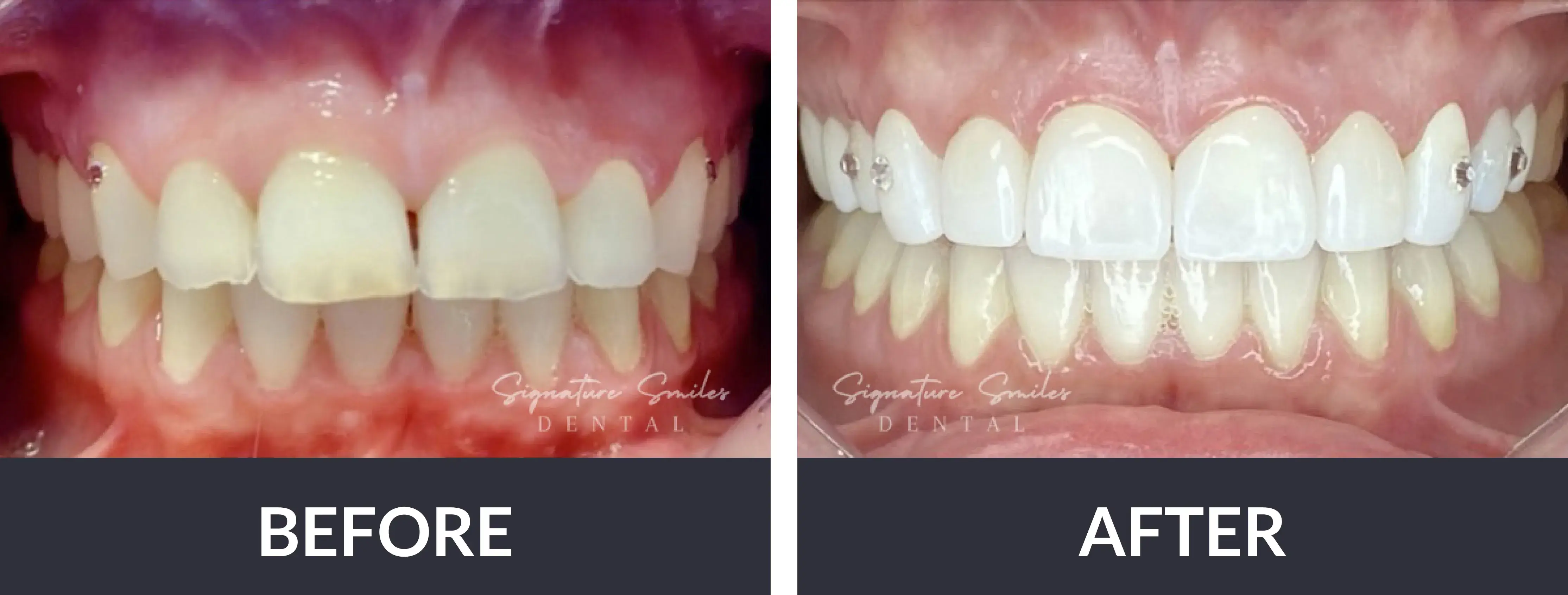 A before and after picture of a smile makeover.