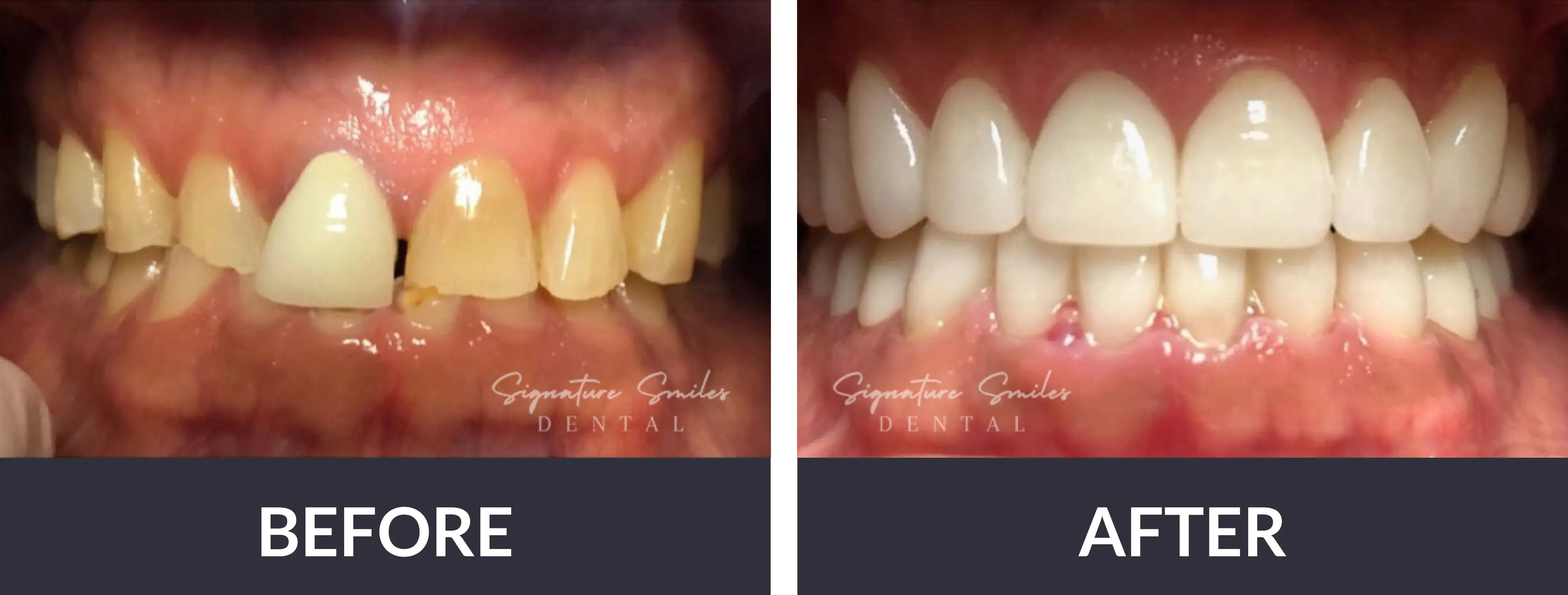 A before and after picture of a smile makeover.