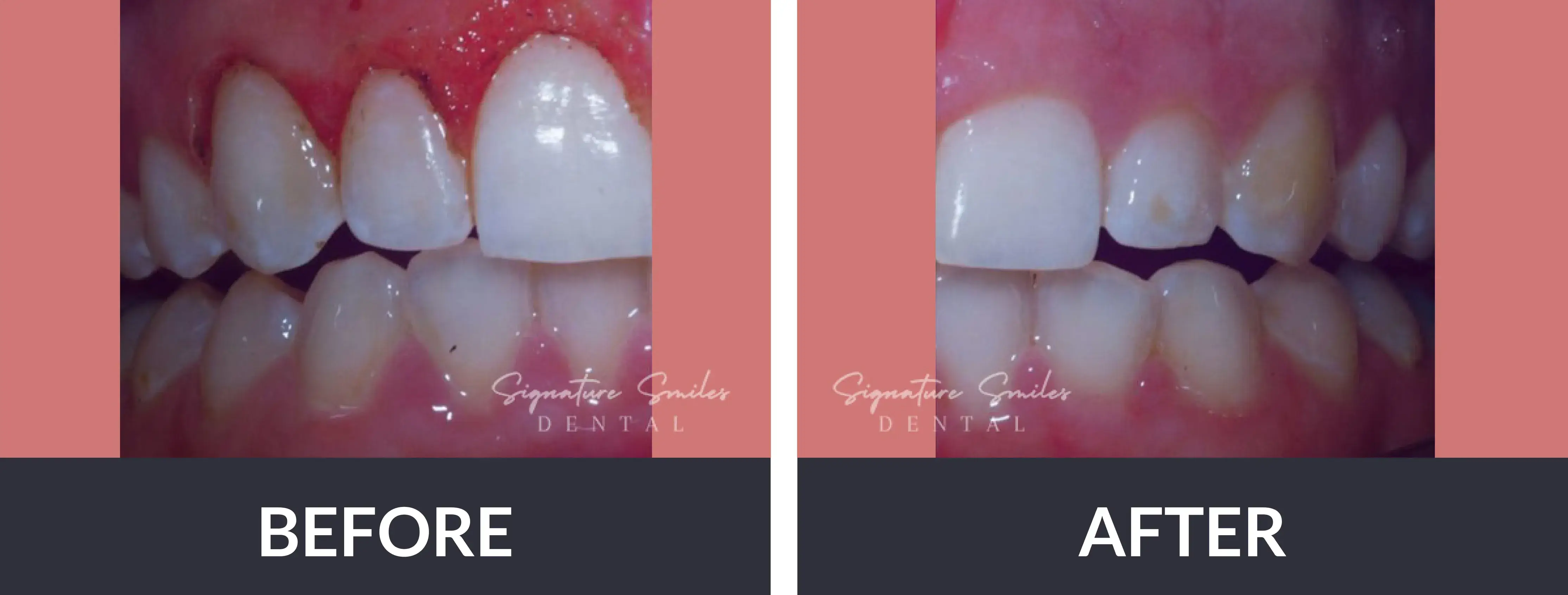 A before and after picture of a smile makeover.