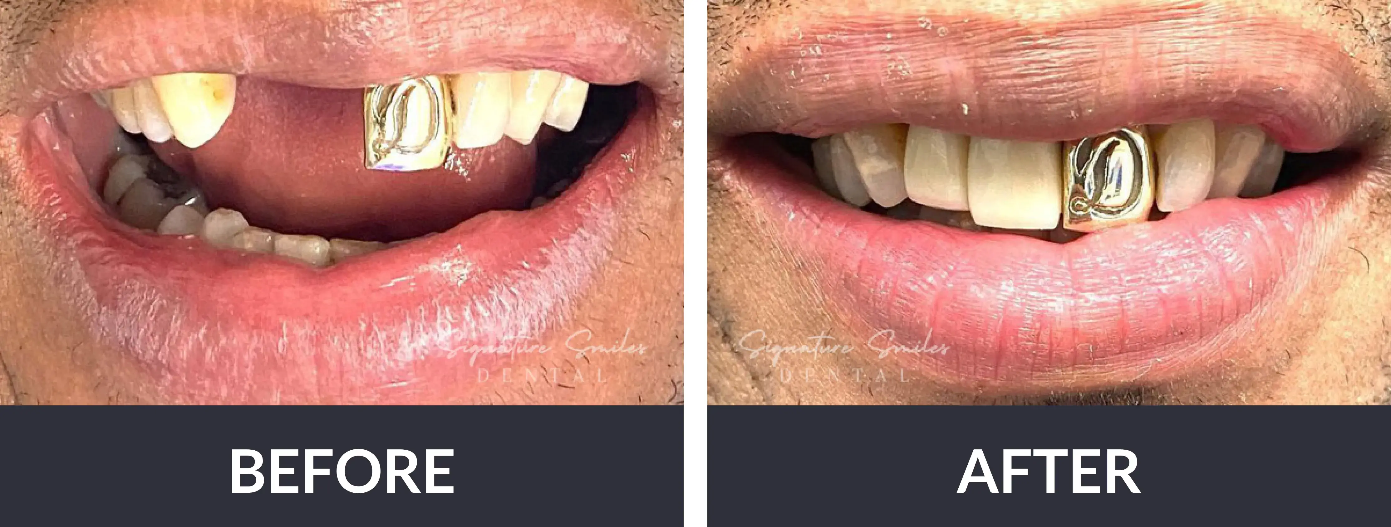 Before and after photos of a man's teeth.