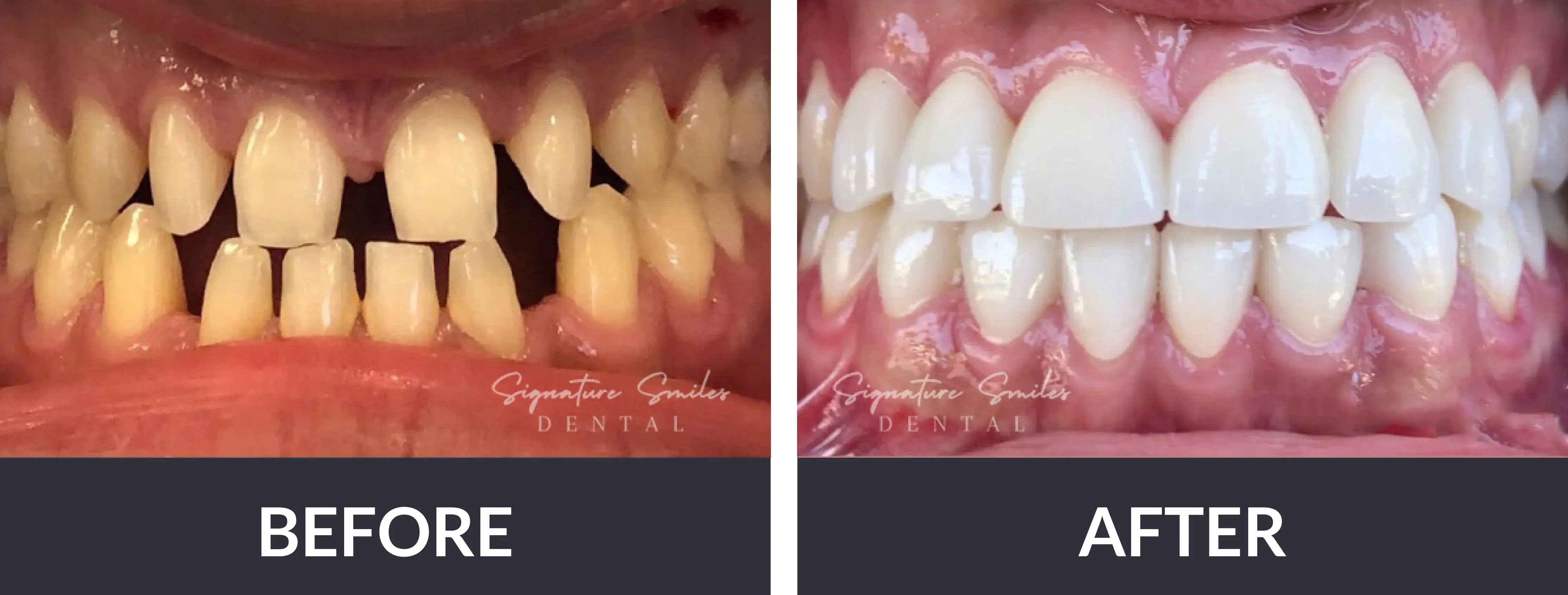 A before and after picture of a smile makeover.