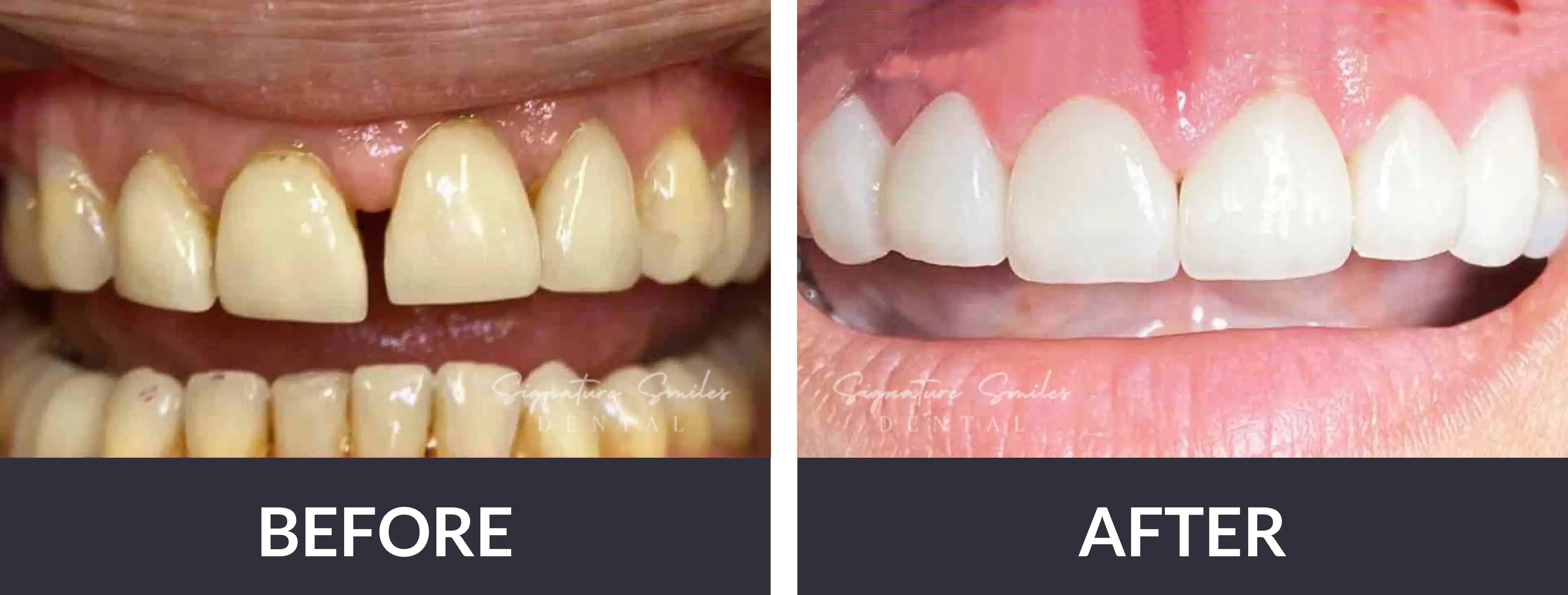 A before and after picture of a woman's teeth.