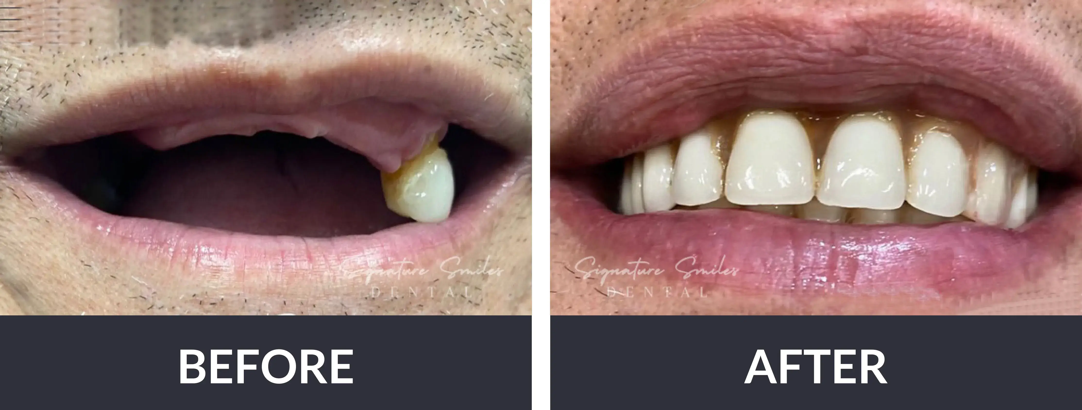 A before and after picture of a man's teeth.