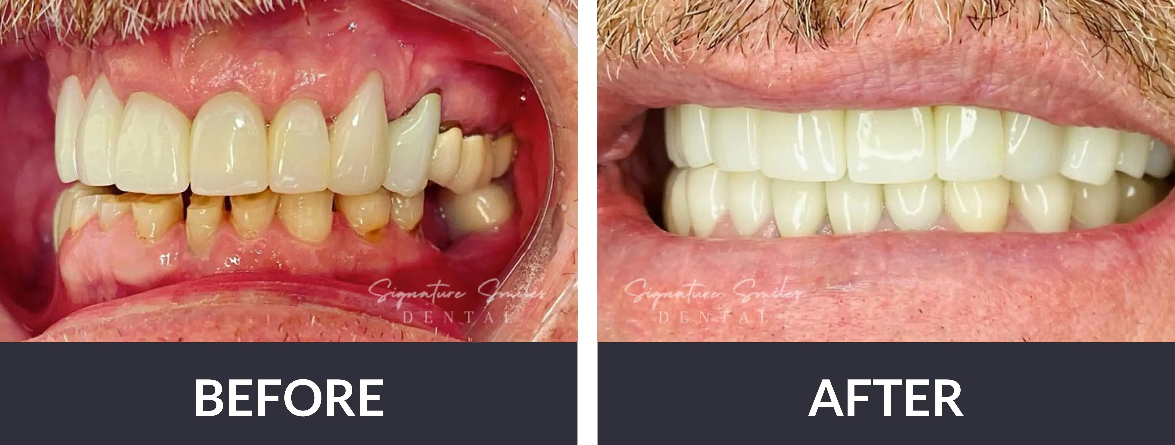 A before and after picture of a man's teeth.
