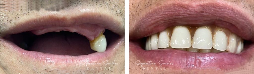 All on X Implants before and after images Signature Smiles Dental