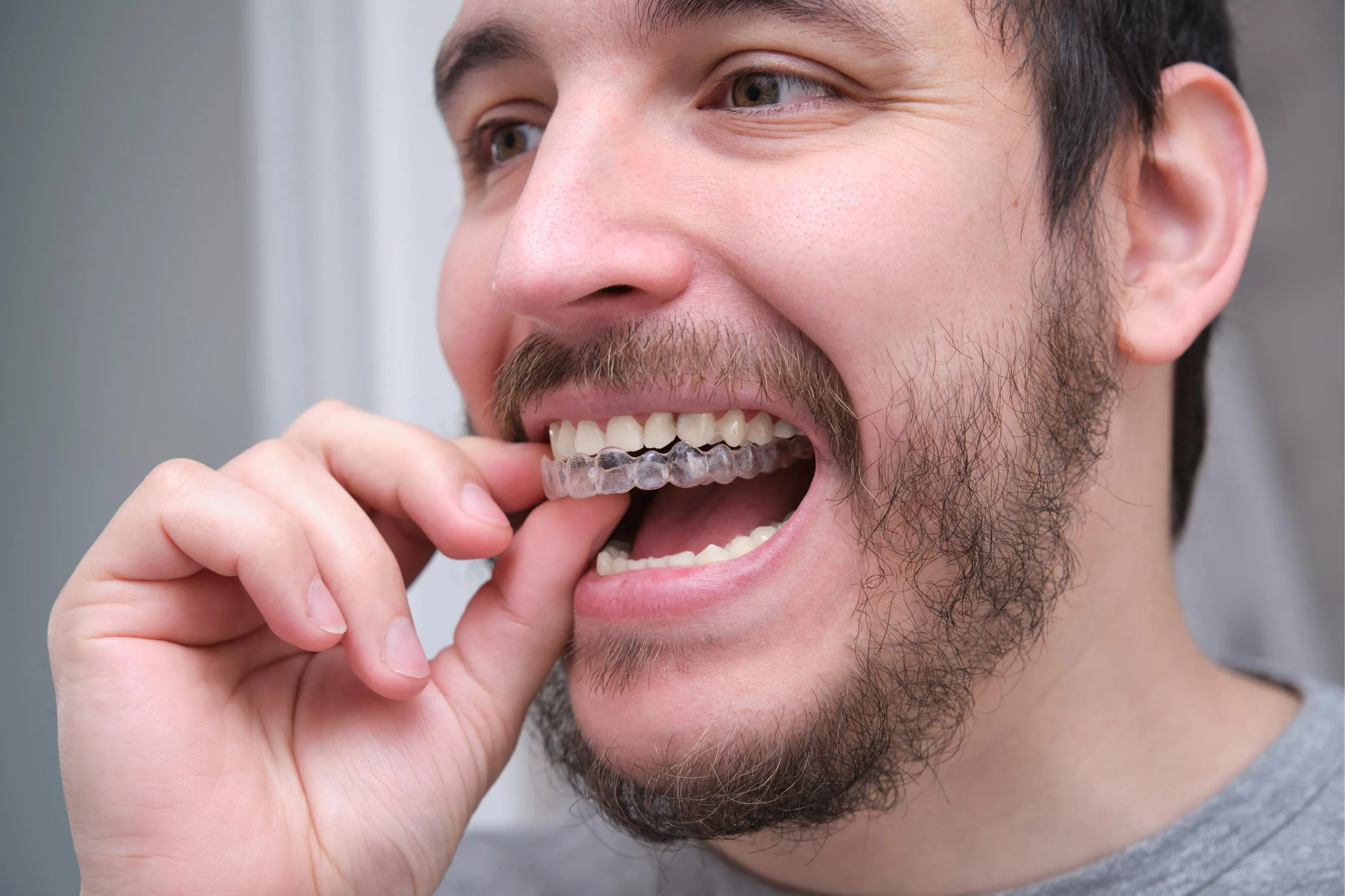 Smiling man inserting clear aligners onto his teeth as part of an orthodontic treatment showing comfort and confidence in his Invisalign journey