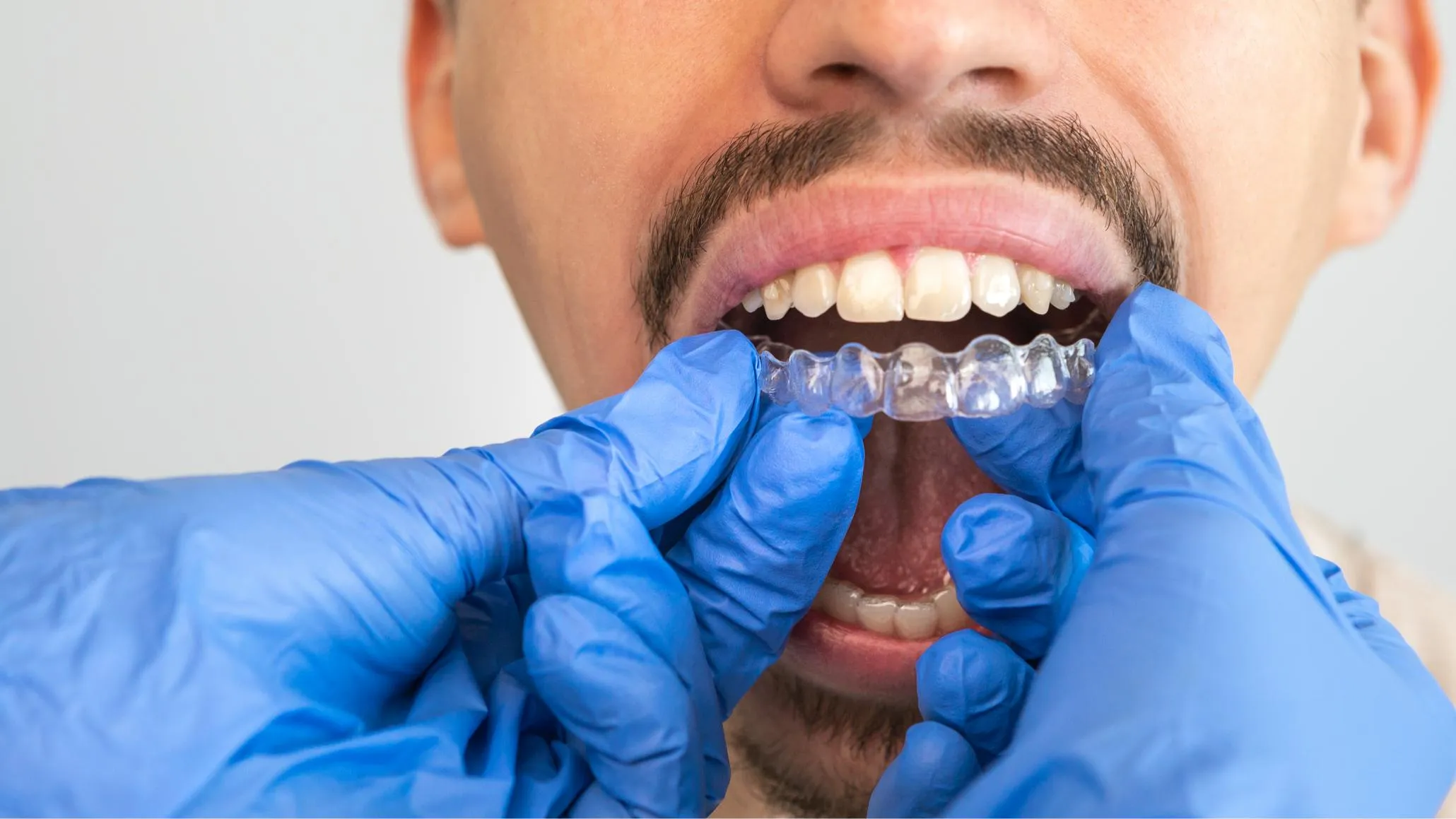 Dentist wearing blue gloves fitting a clear aligner on a male patient’s teeth during an Invisalign appointment emphasizing precision and professional orthodontic care
