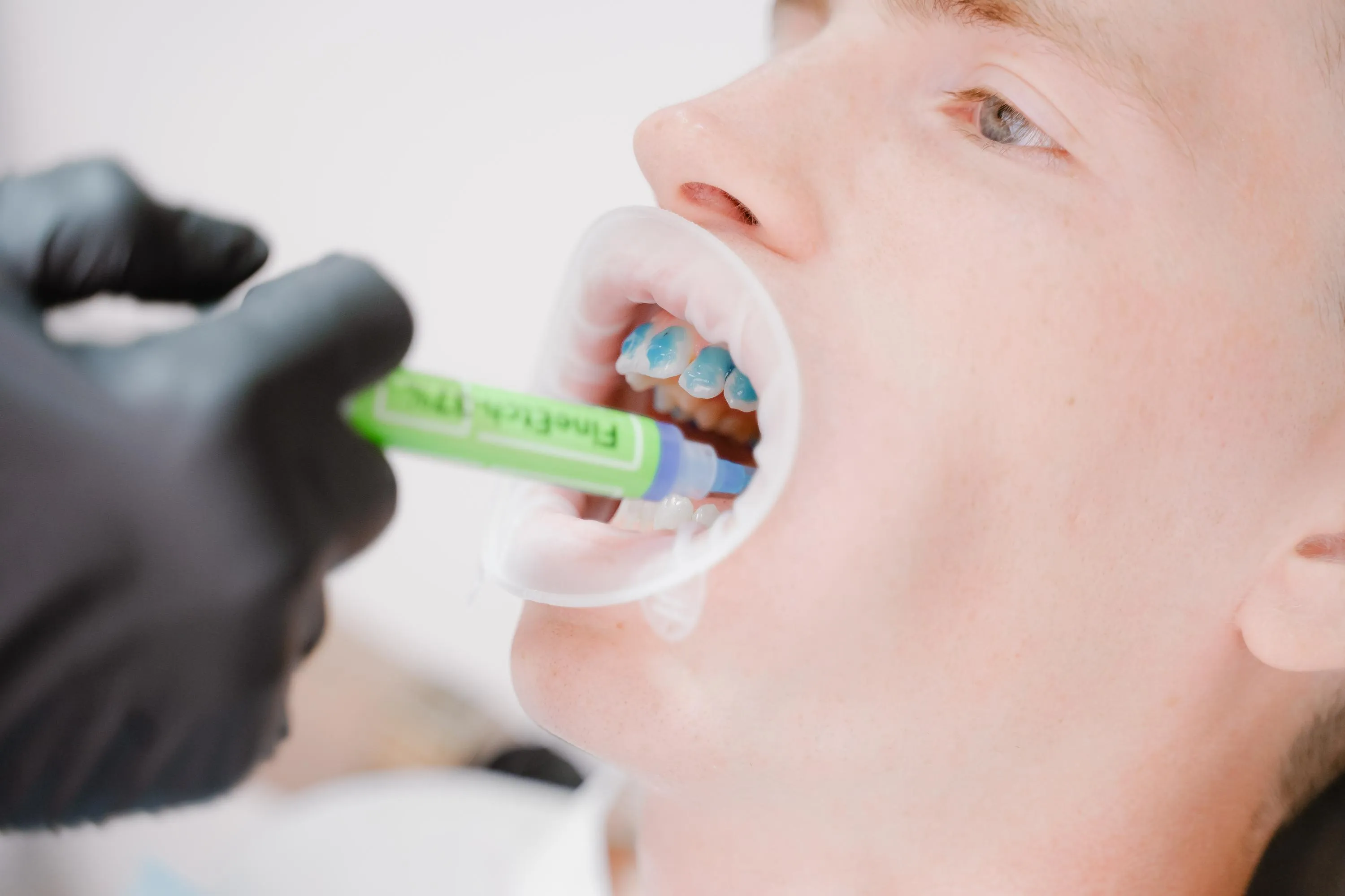 Dentist applying professional whitening gel to a male patient’s teeth during an in-office teeth whitening procedure to enhance smile brightness and remove stains