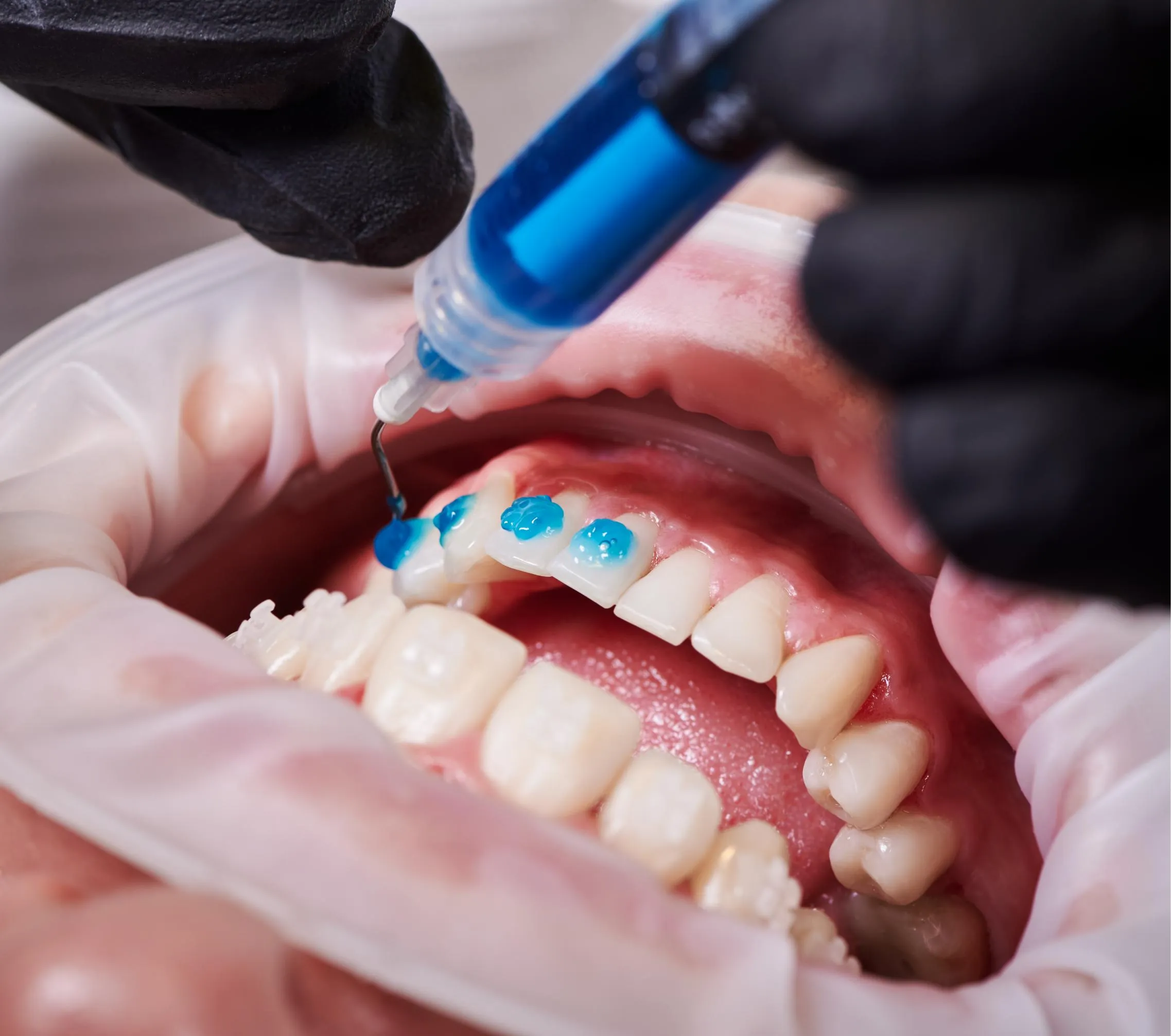 Dentist using a small dental scaler on a mouth model to demonstrate cleaning techniques for removing plaque and maintaining healthy teeth and gums