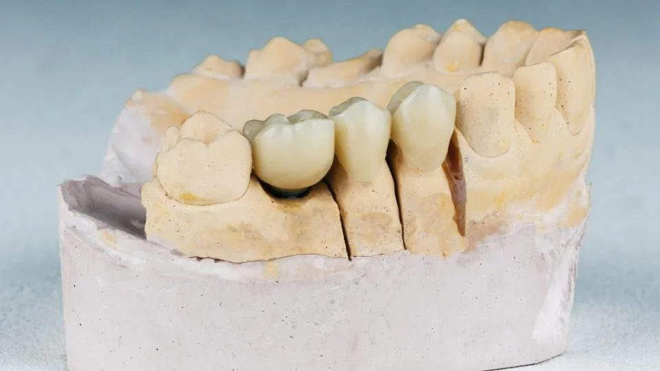 Close-up of a dental model showing a fixed porcelain bridge mounted on a plaster cast demonstrating dental laboratory fabrication for crown and bridge restorations