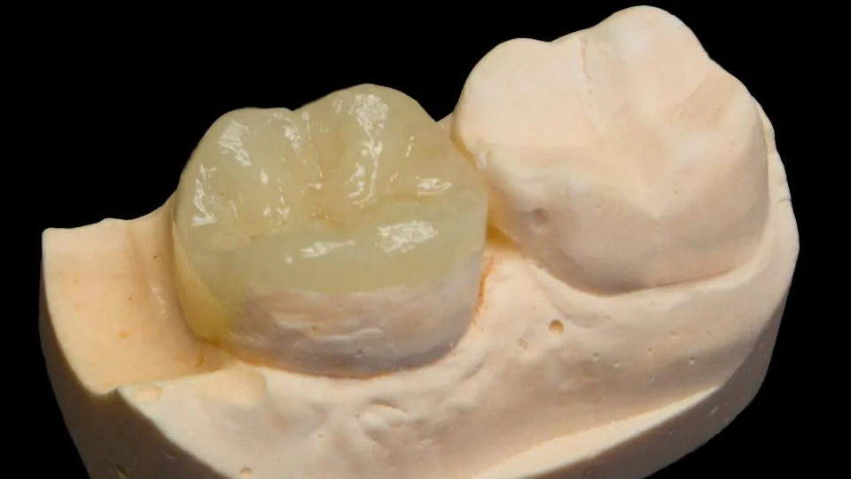 Single ceramic dental crown placed on a realistic tooth mold showing detailed color shading and contour design for a natural-looking restorative result